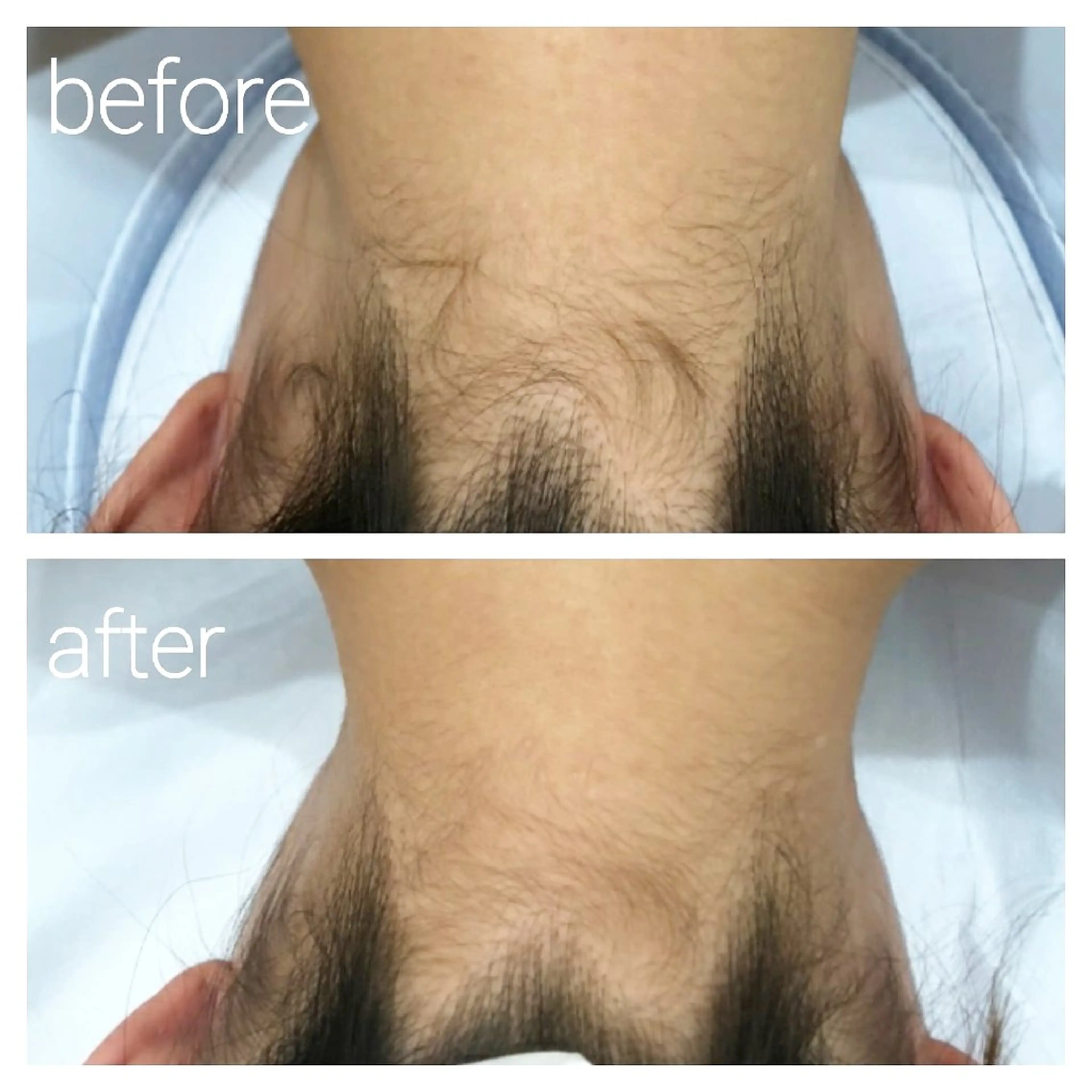 限定価格✨レディース全身脱毛❇️顔VIO含むの写真