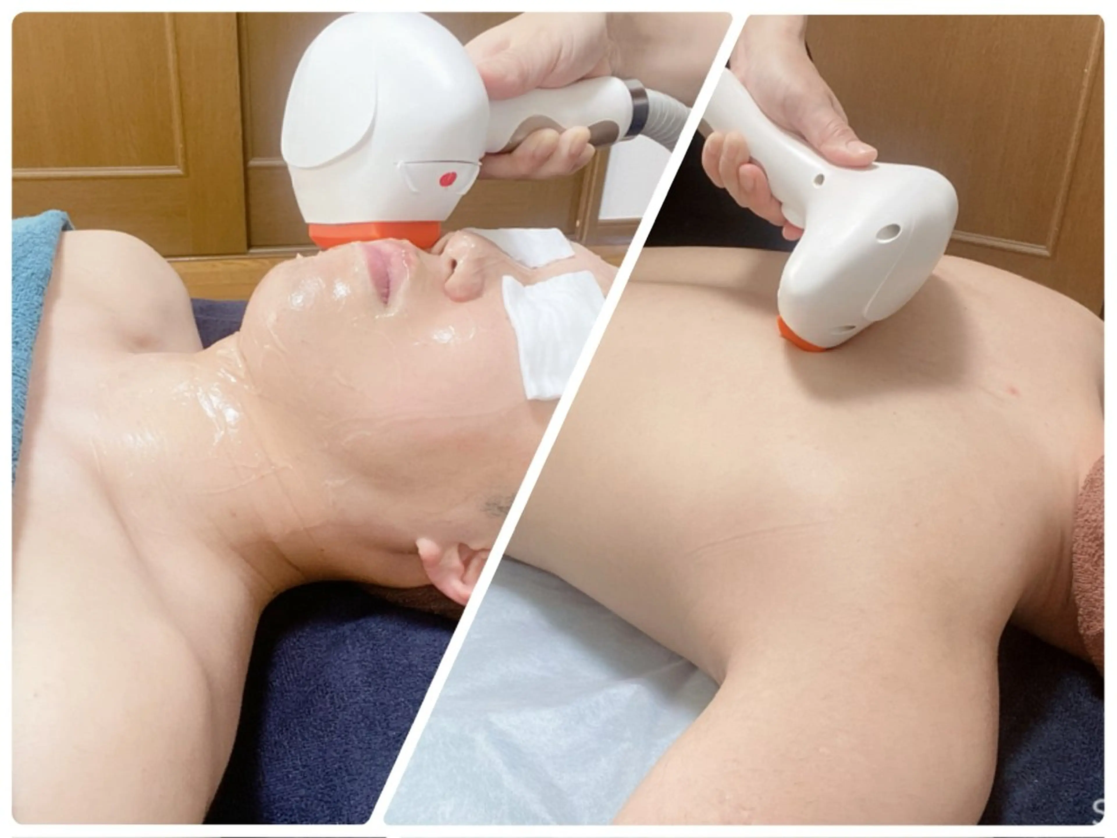 〈メンズ〉顔首全体➕全身脱毛の写真