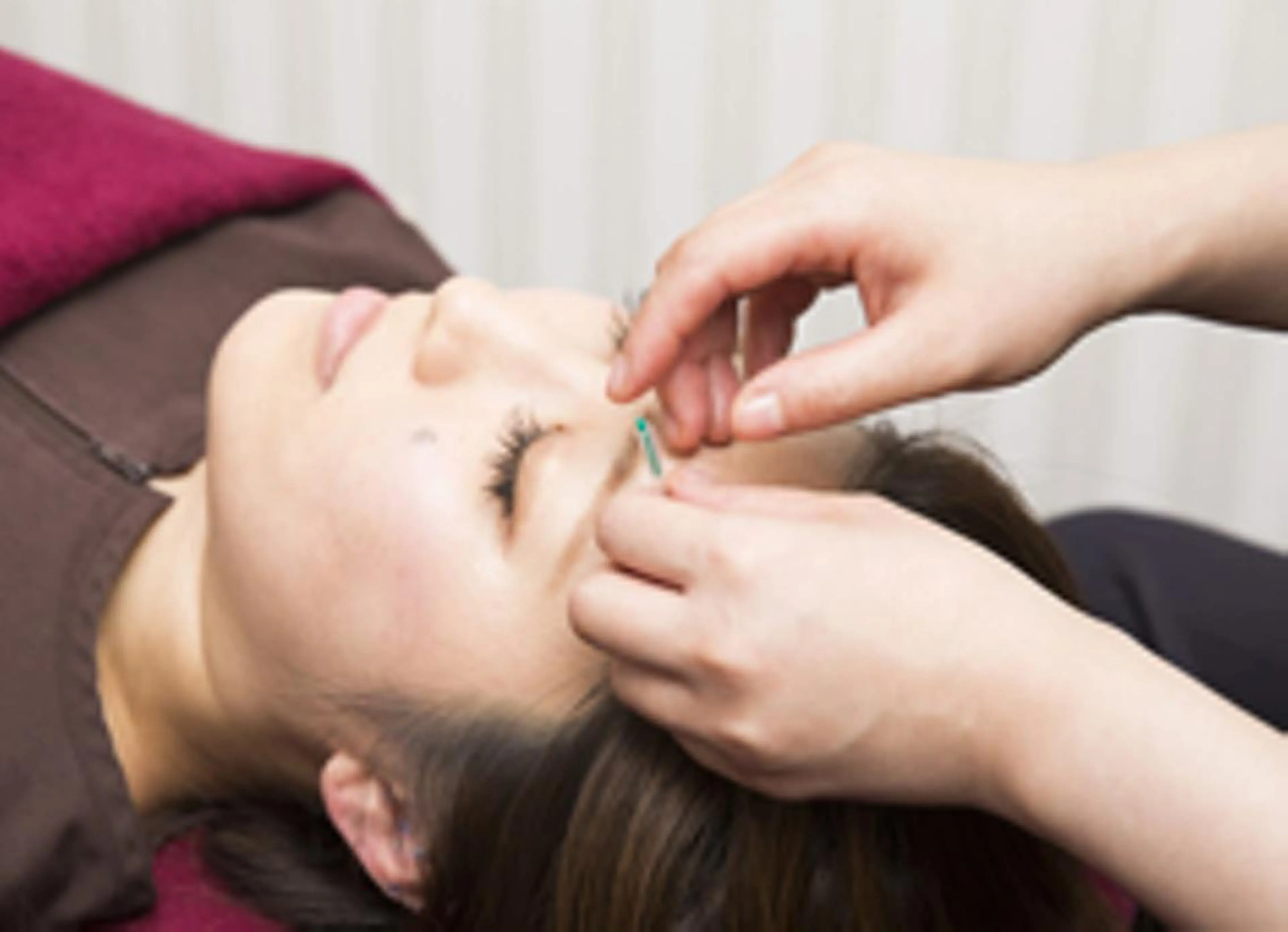 【minimo限定🉐】🎗️大人気🎗️美容鍼＋お身体が気になる方にオススメ60分(美容鍼＋微弱電流＋整体)の写真