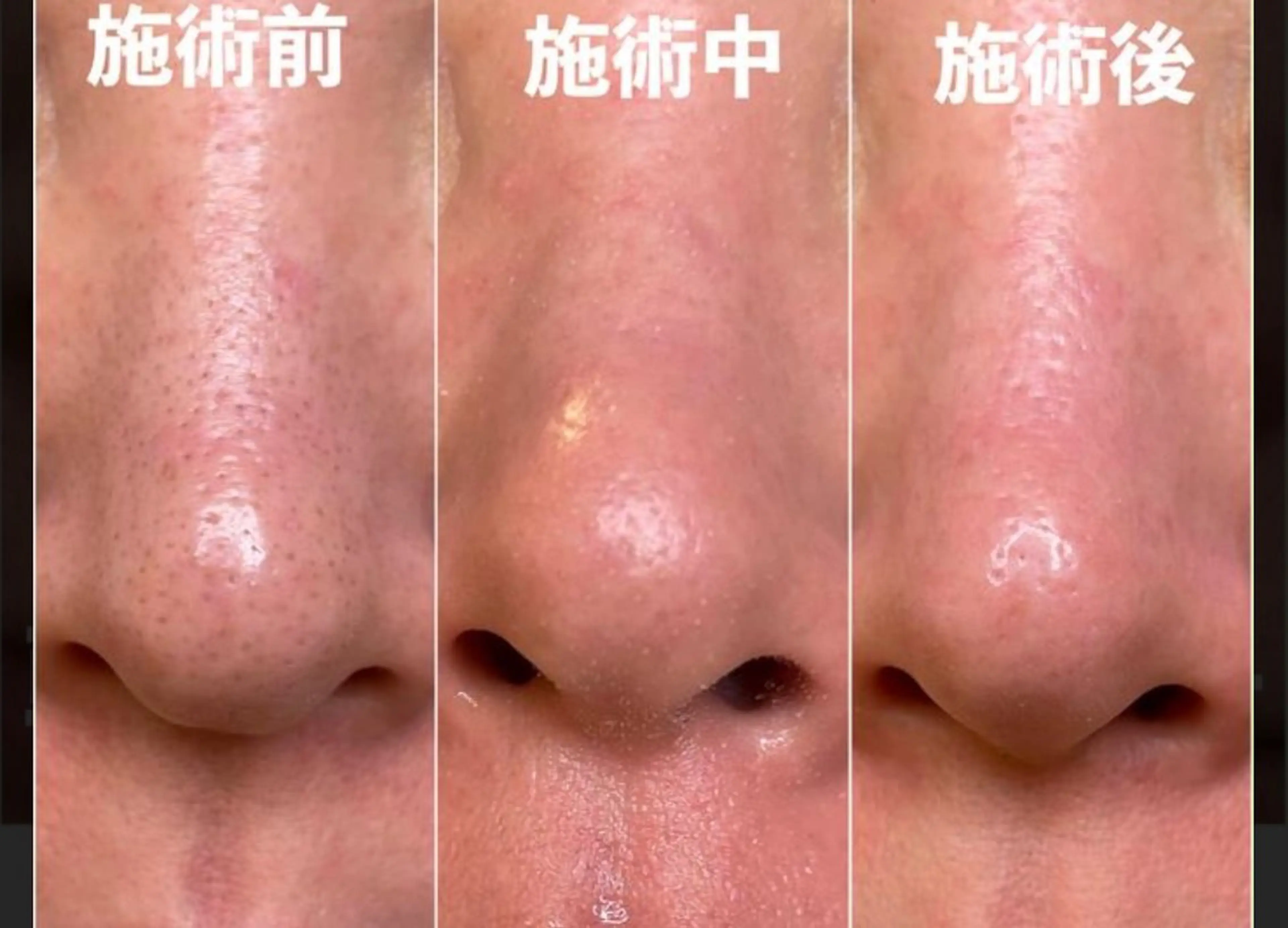 毛穴角栓洗浄吸引60分 【men’s】もok          13200→6600の写真