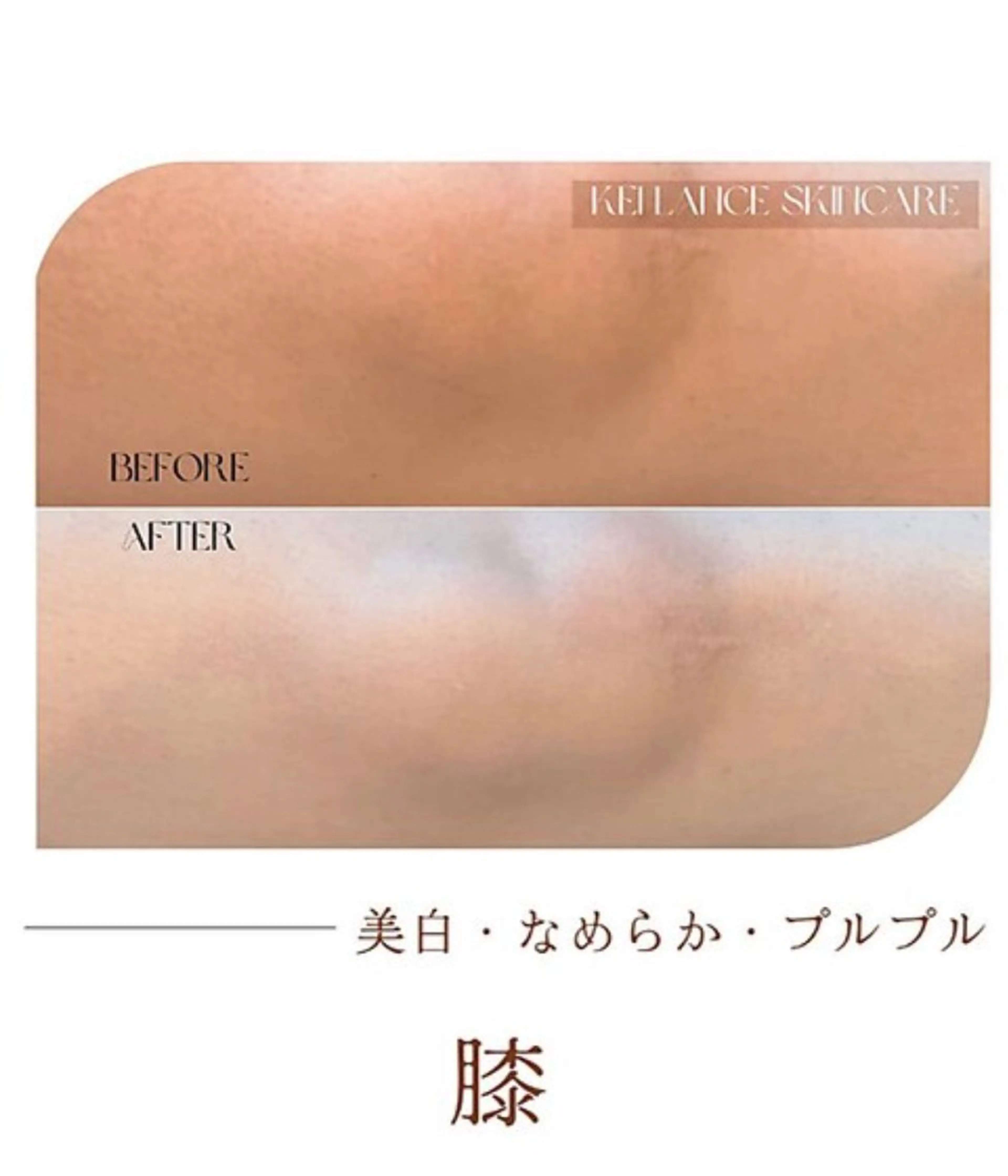 ひざのくすみ★即効撃退】白雪肌ボディコース《両ひざのみ》¥4,400の写真