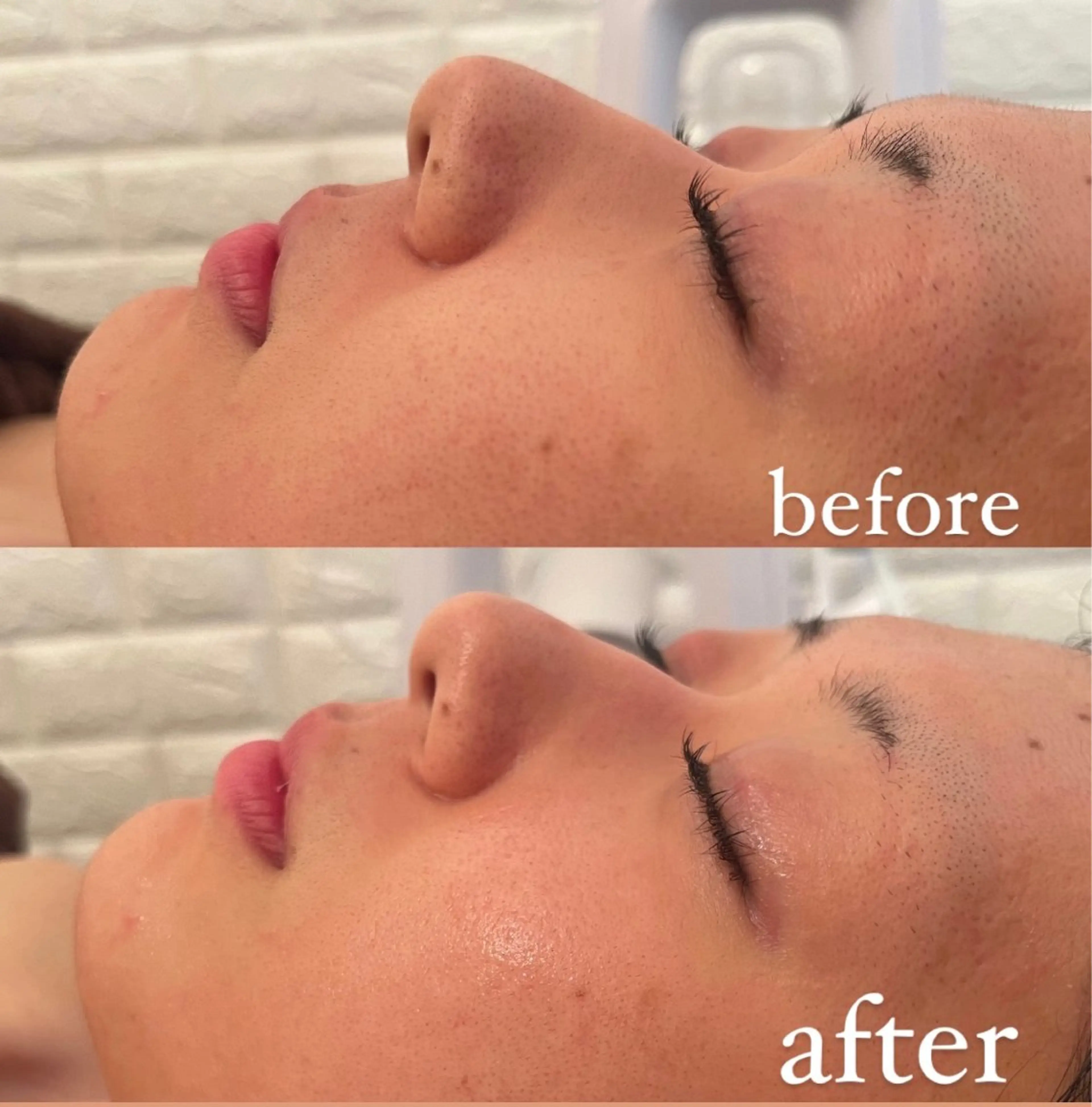 毛穴ケア/毛穴診断/ 毛穴洗浄〔心斎橋〕のエステ・リラクイメージ