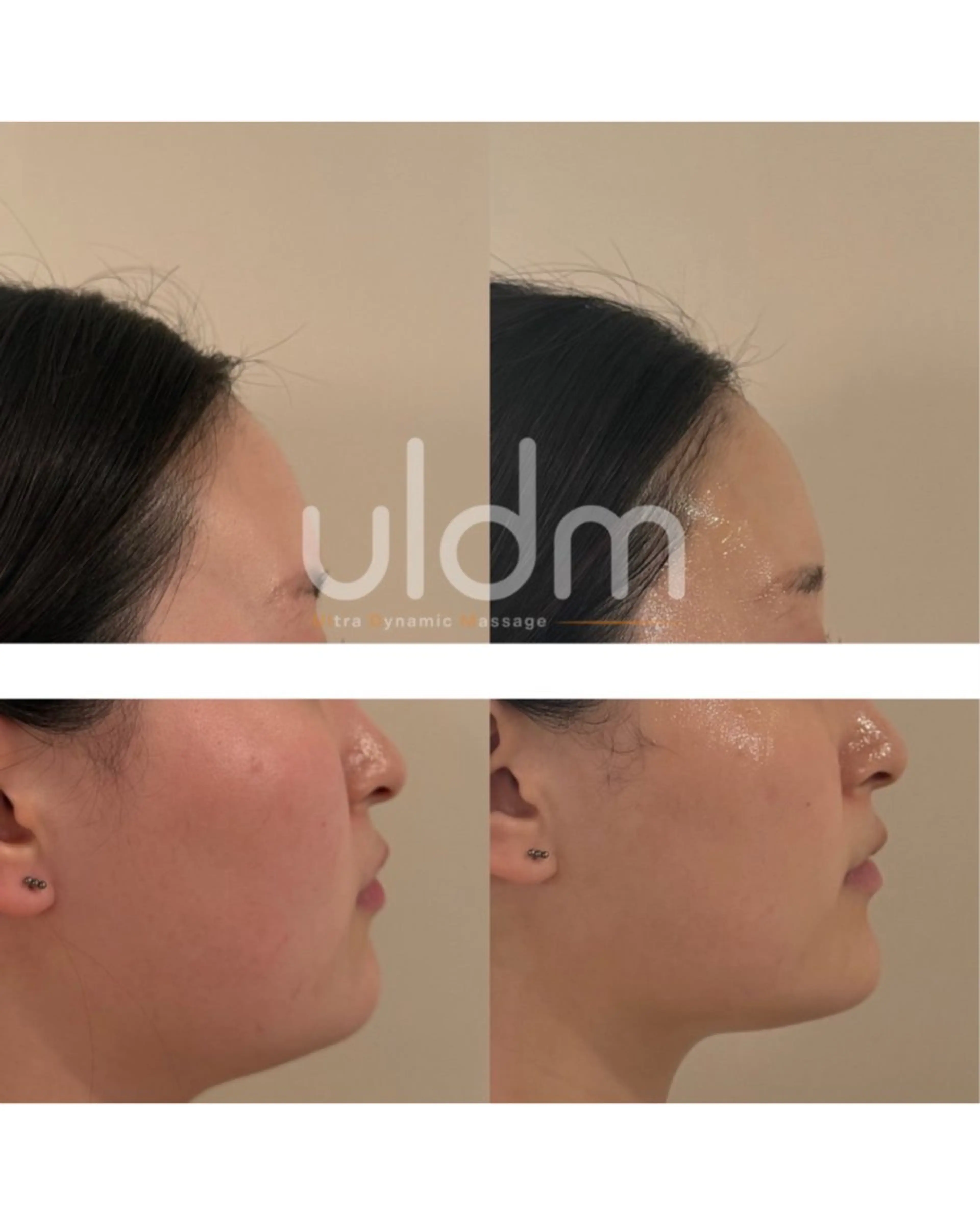 【切らない小顔Vライン】韓国/日本初上陸！《ウルドム》コラーゲンフィラー💉+水滴LDM/最新小顔管理◎の写真