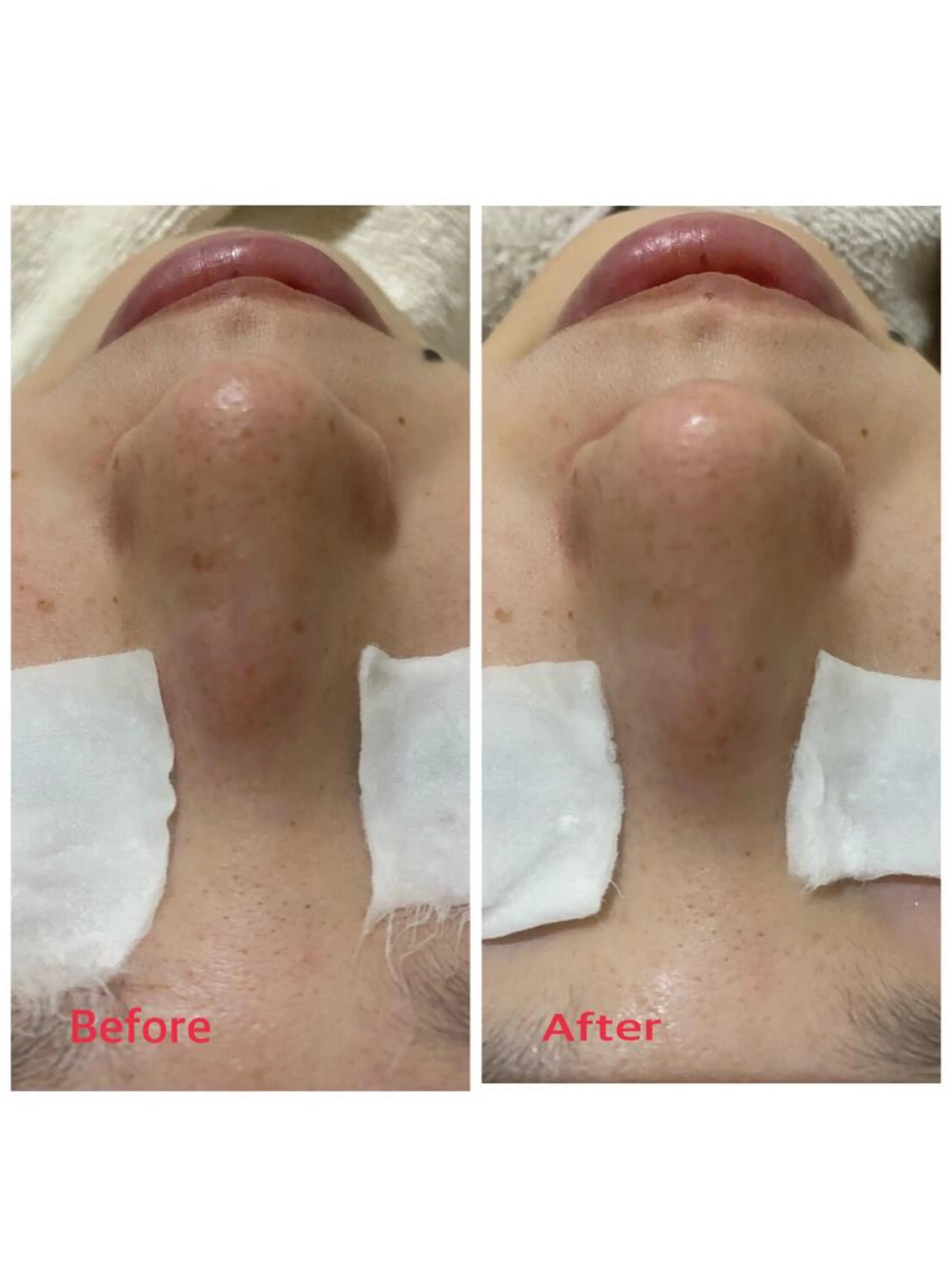 秋の毛穴🍂ポアレスラボ開発！毛穴洗浄後紫外線を浴びたダメージ肌にビタミン誘導体VCエチル配合美容液をエレクトロ導入⭐️の写真