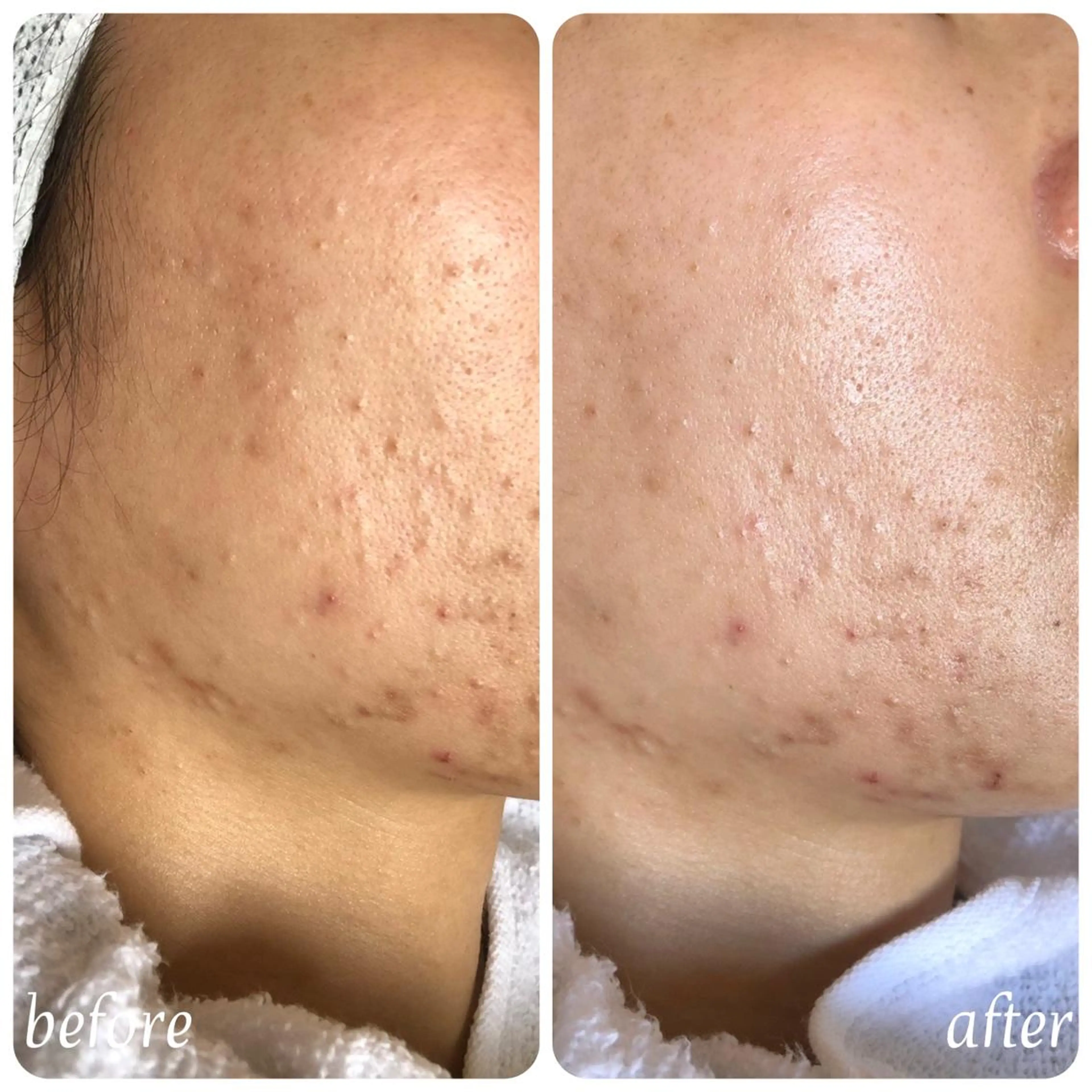 【4~6月限定‼️】スキンチェック&フェイシャルエステ体験💆🏻‍♀️の写真