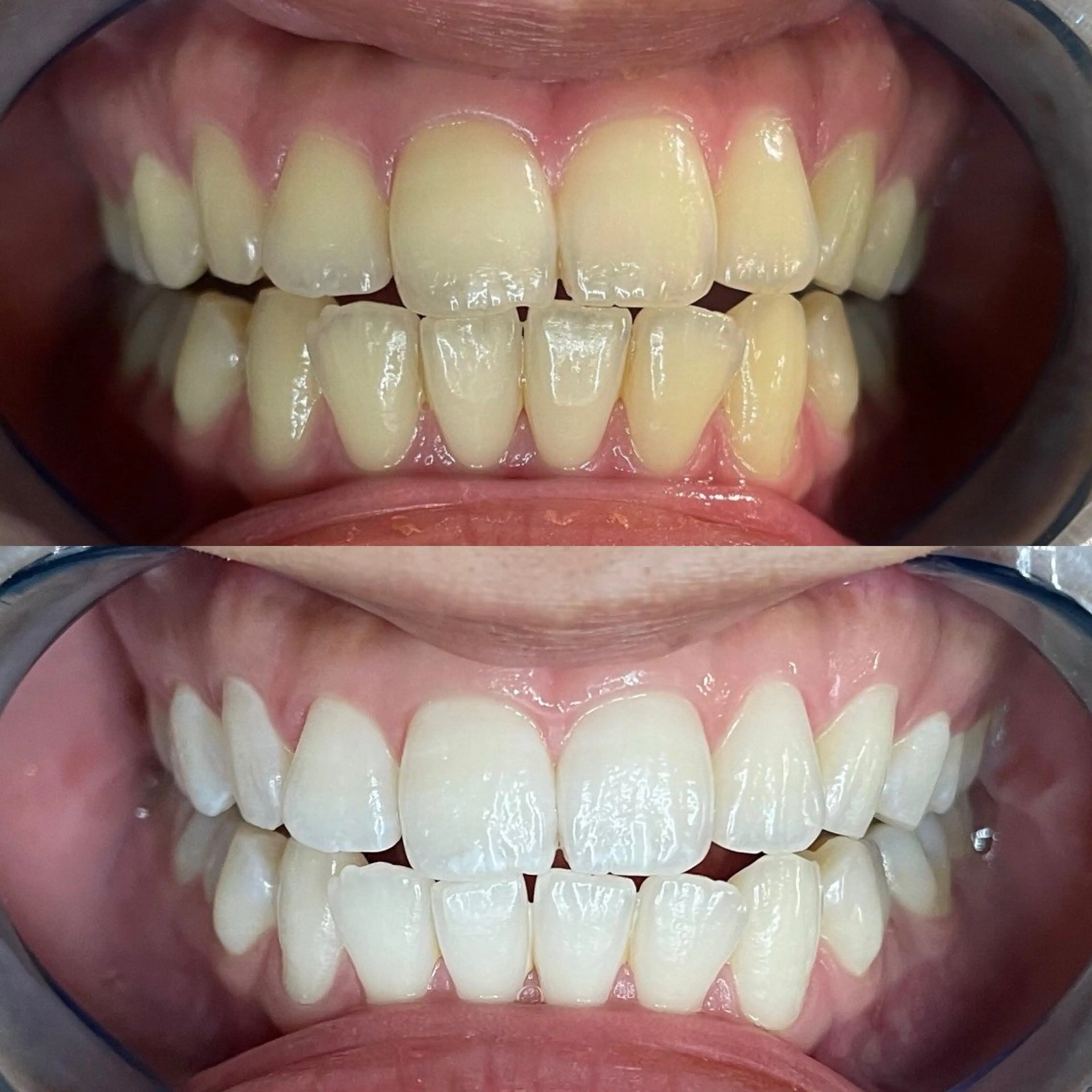 【初めての方専用💎】セルフホワイトニング体験✨️超🉐1,000円🦷✨15分照射で白さ実感🔥の写真