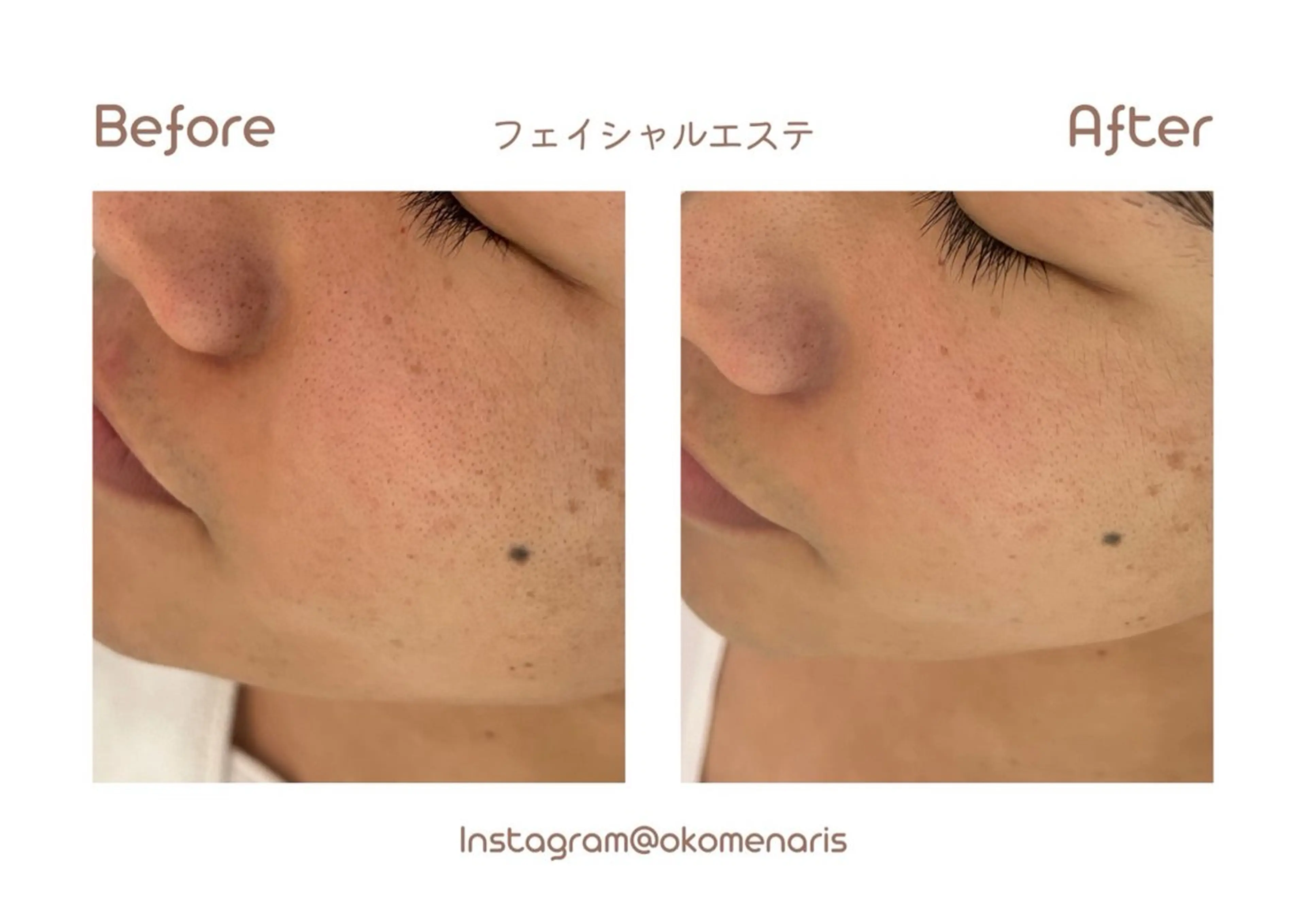 【フェイシャル】【メンズ】＋肌質改善パーソナルパック🧘🏻の写真