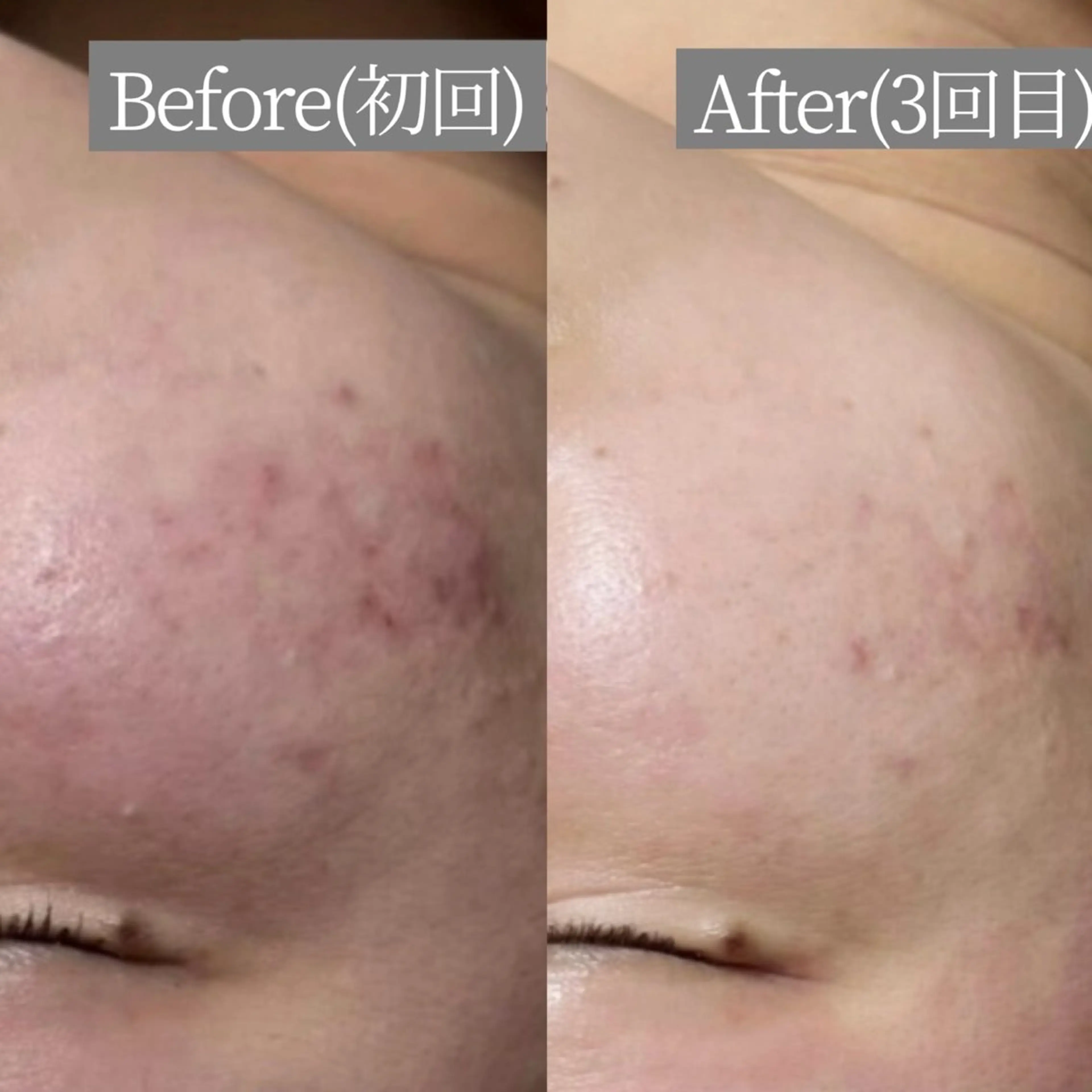 エステ リラク 毛穴・ニキビケア　ハーブピーリング【肌管理専門店】WHITE AQUA鳳店所属・ホワイトアクア 鳳店のエステ・リラクイメージ