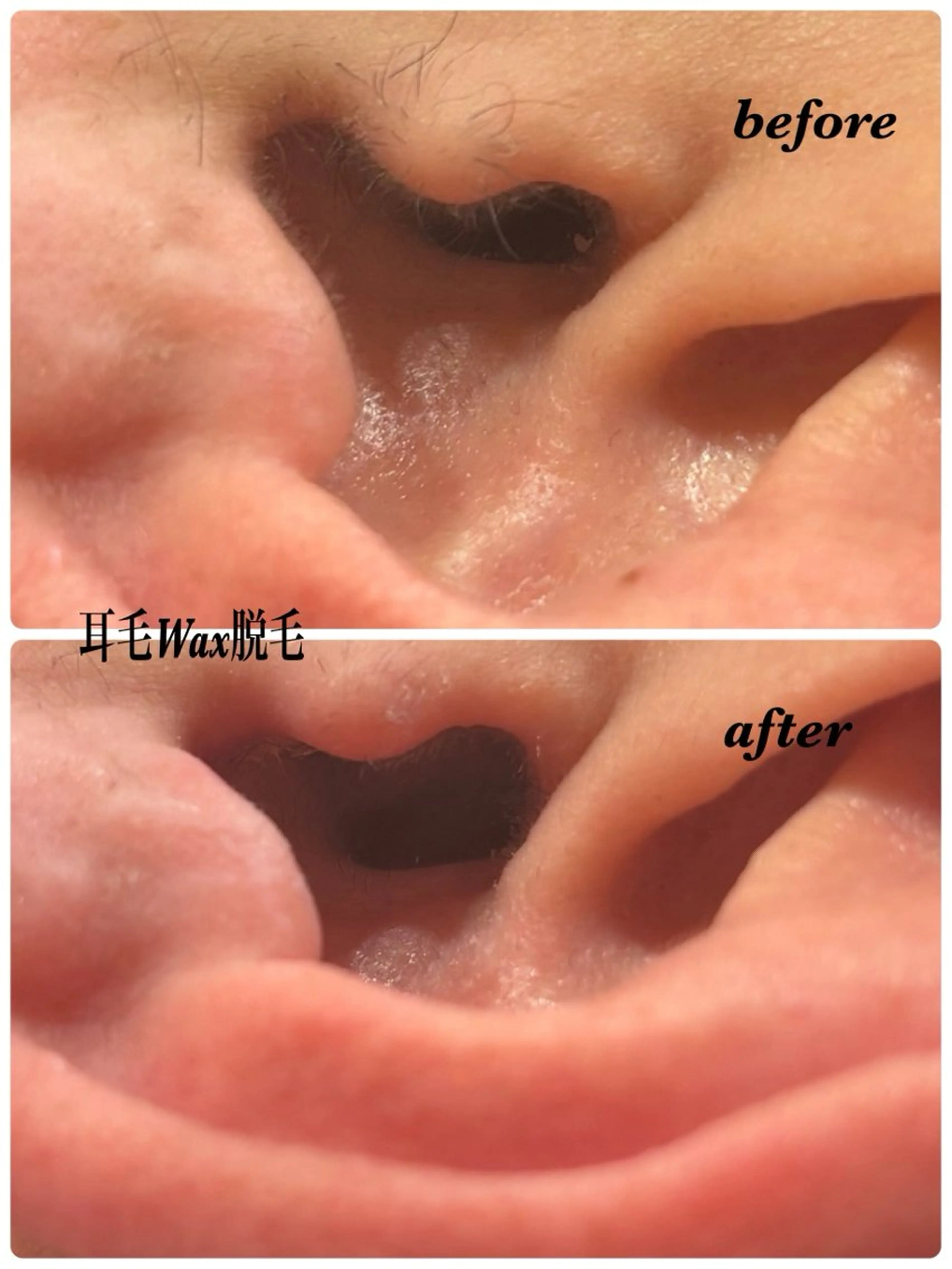 ハーブピーリング/韓国肌管理/フェイシャル/毛穴洗浄/眉毛/顔脱毛【糸脱毛専門】rev所属・ハーブピーリング🌹 毛穴洗浄❤️眉waxのエステ・リラクイメージ