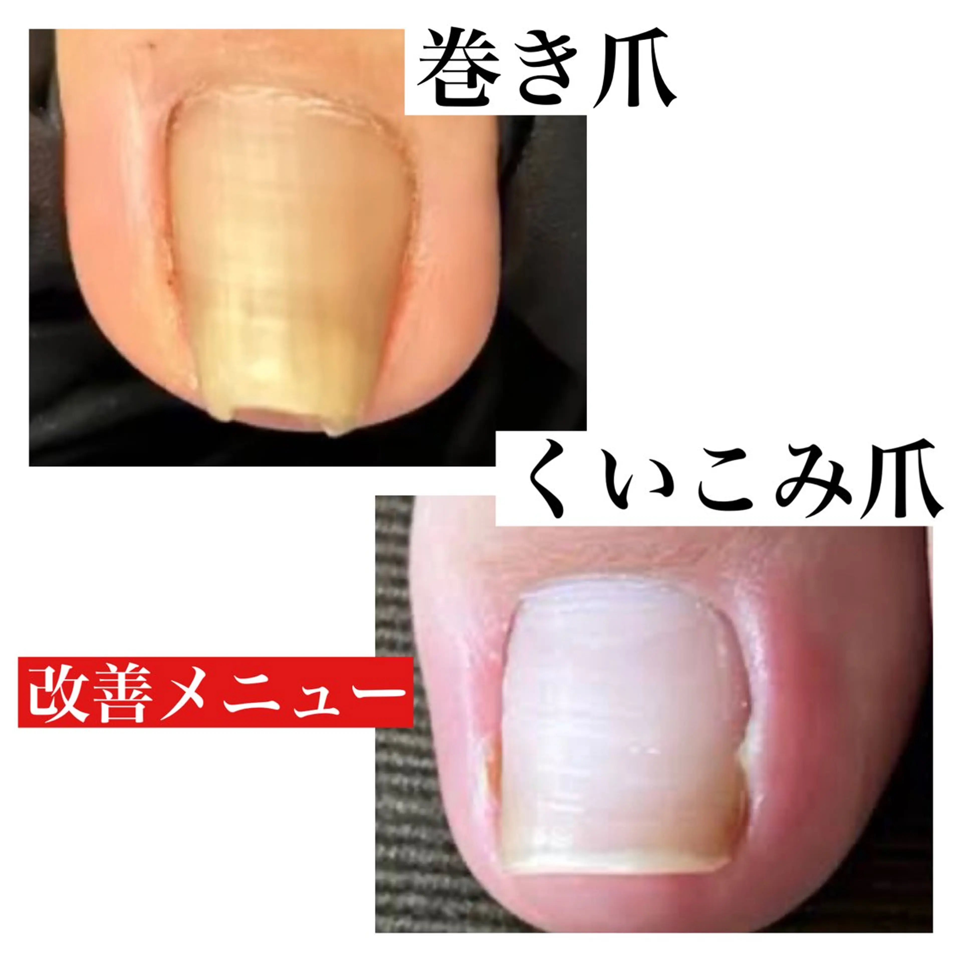 巻き爪矯正　特殊な透明なプレートで痛みからの解放を目指そう！隠れ巻き爪の方もおおいですよね。お悩み解決しませんか？の写真