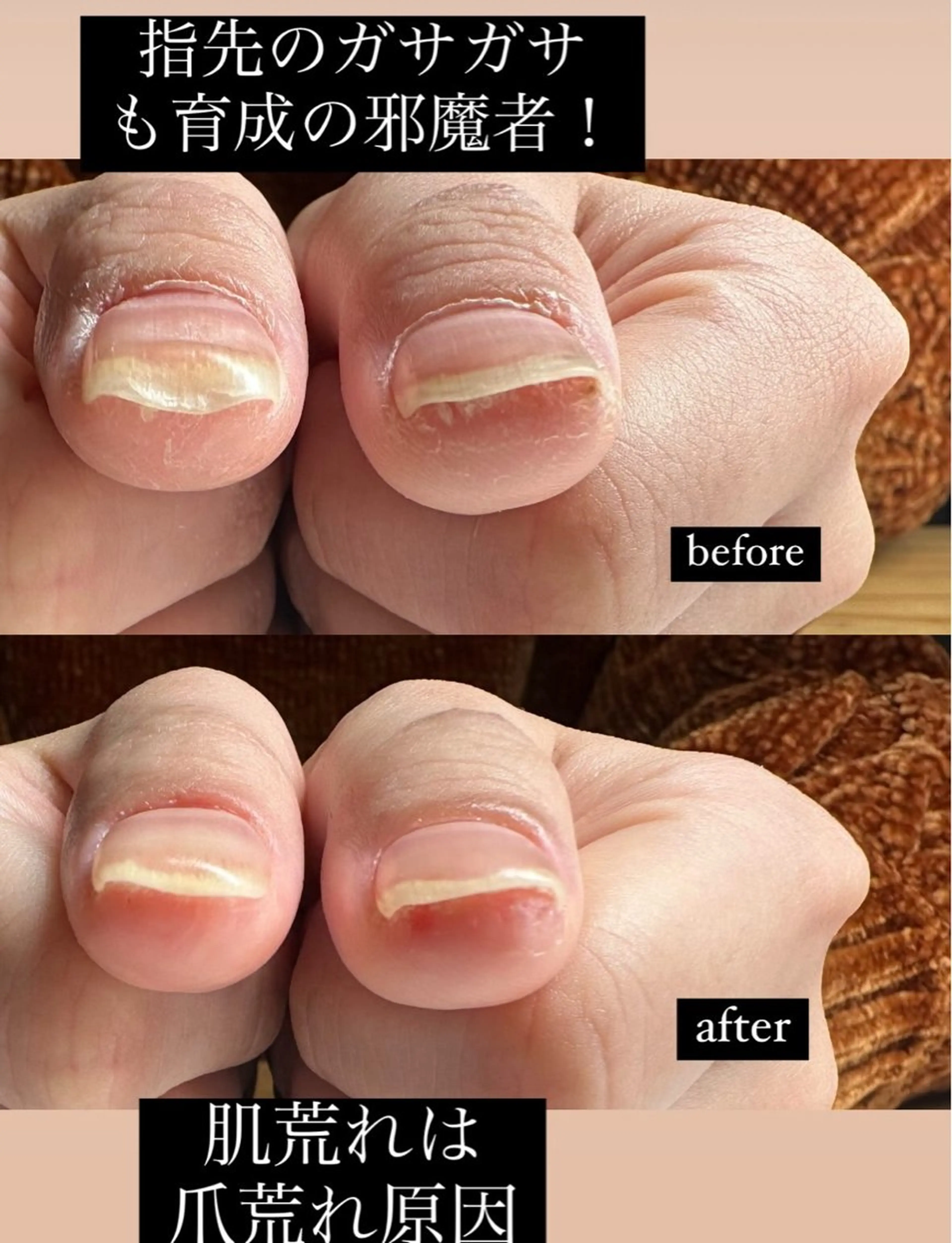 ネイル 深爪矯正専門店ネイルサロンKUU所属・深爪矯正専門店 ネイルサロンKUUのネイルデザイン