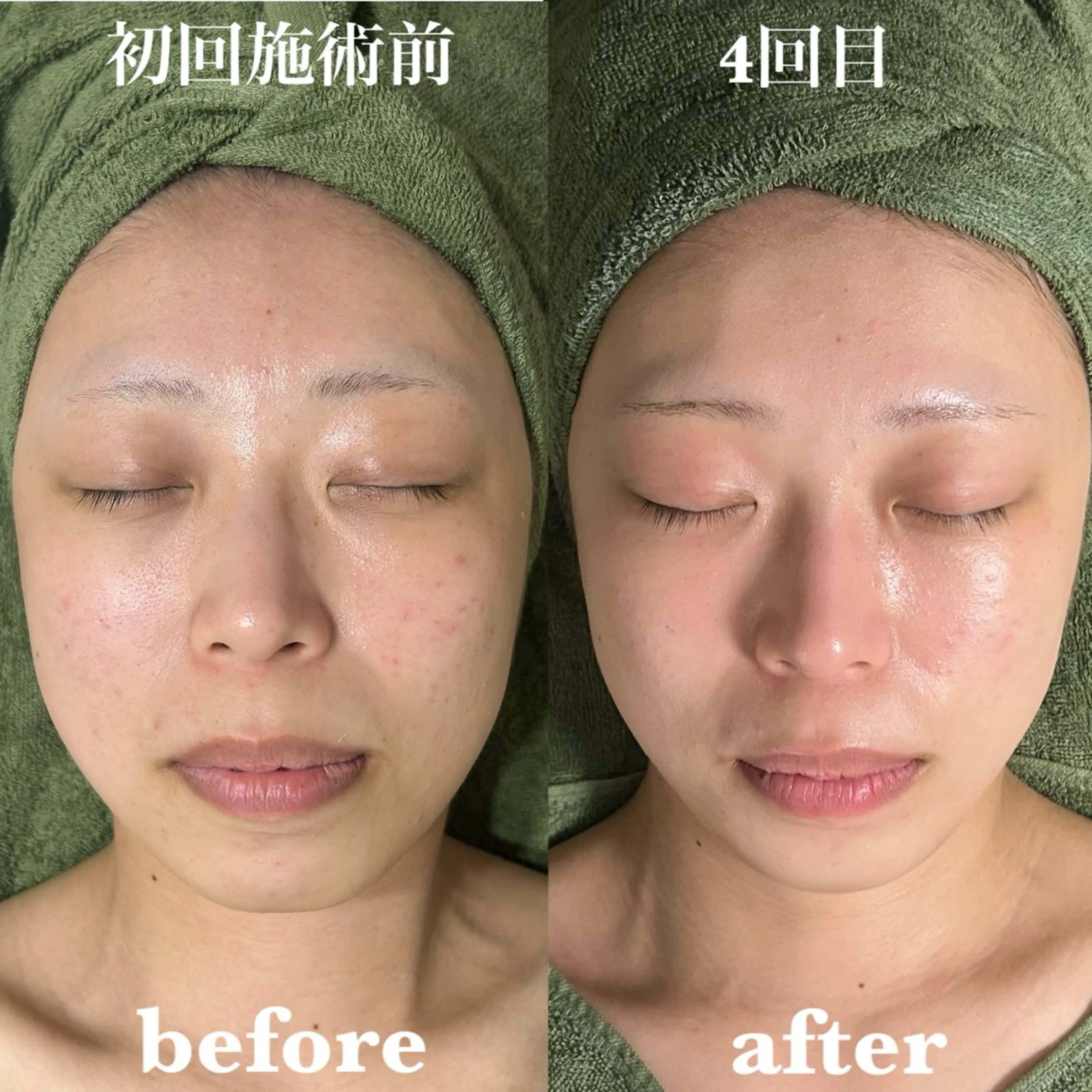 【スタンダード】陶肌トリートメント▶¥7,700(陶肌パウダー1ｇプレゼント価格)の写真