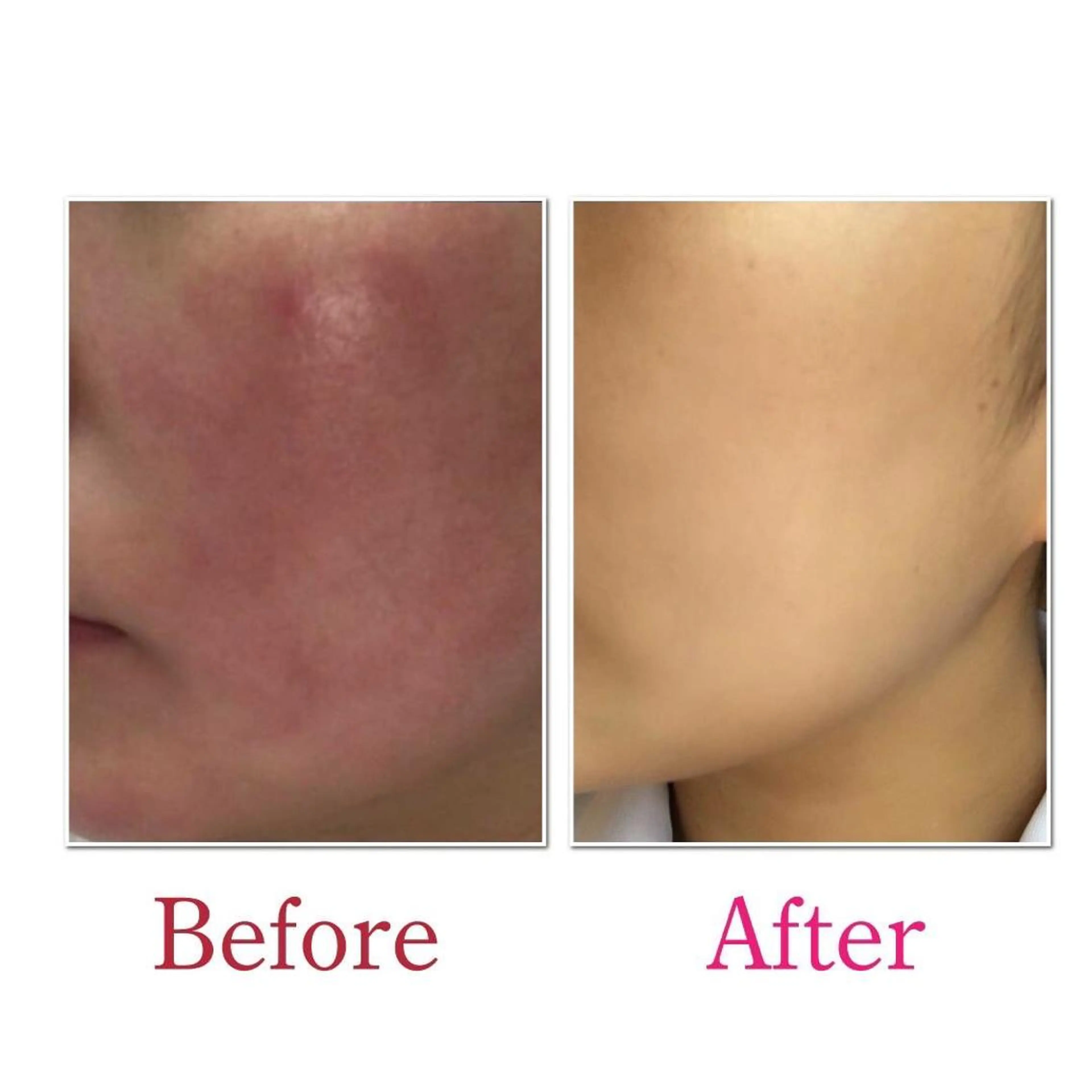 ニキビ・ニキビ跡専門 Solaのエステ・リラクイメージ