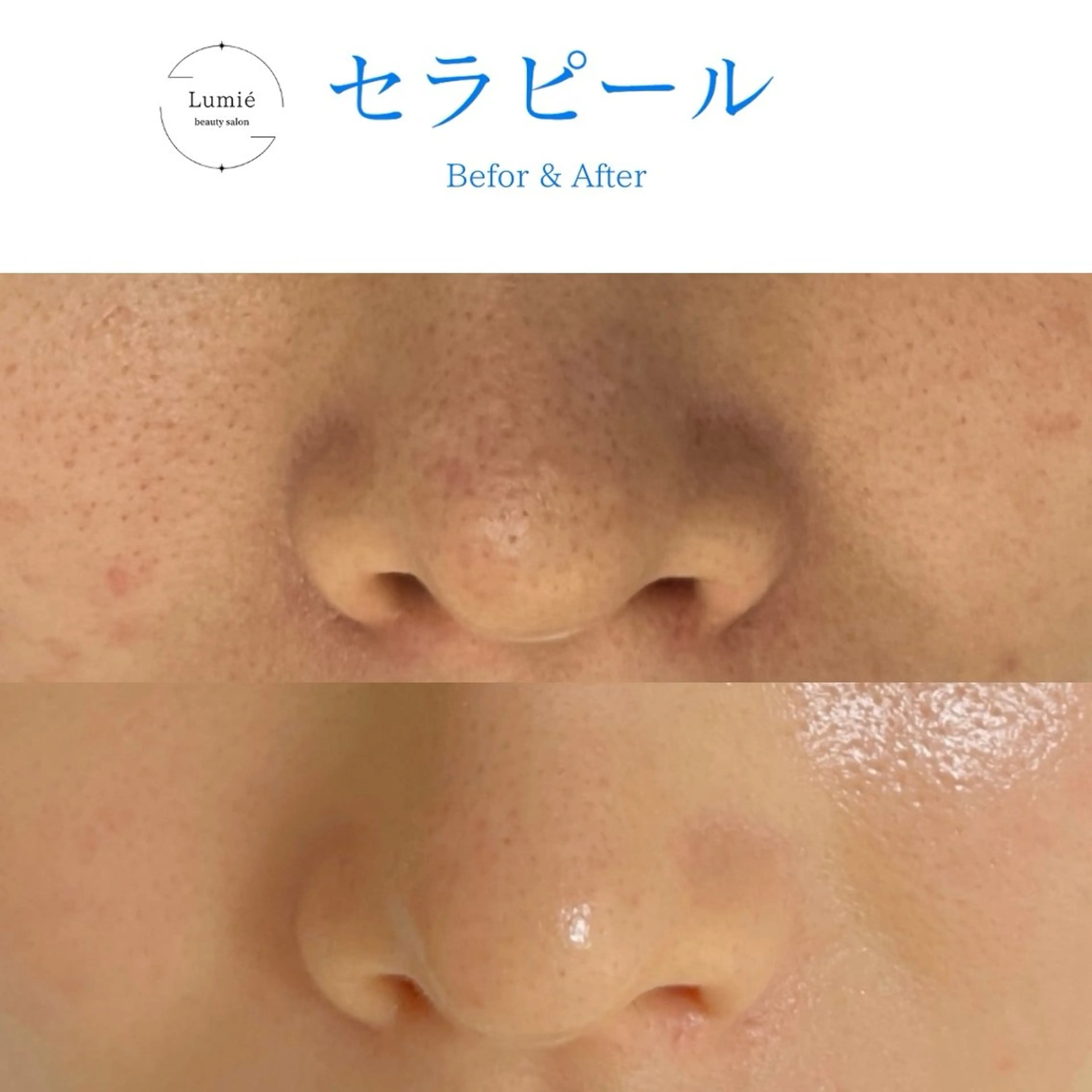 肌育専門サロンLumie所属・水玉リフティング🫧 Lumie恵比寿店のエステ・リラクイメージ