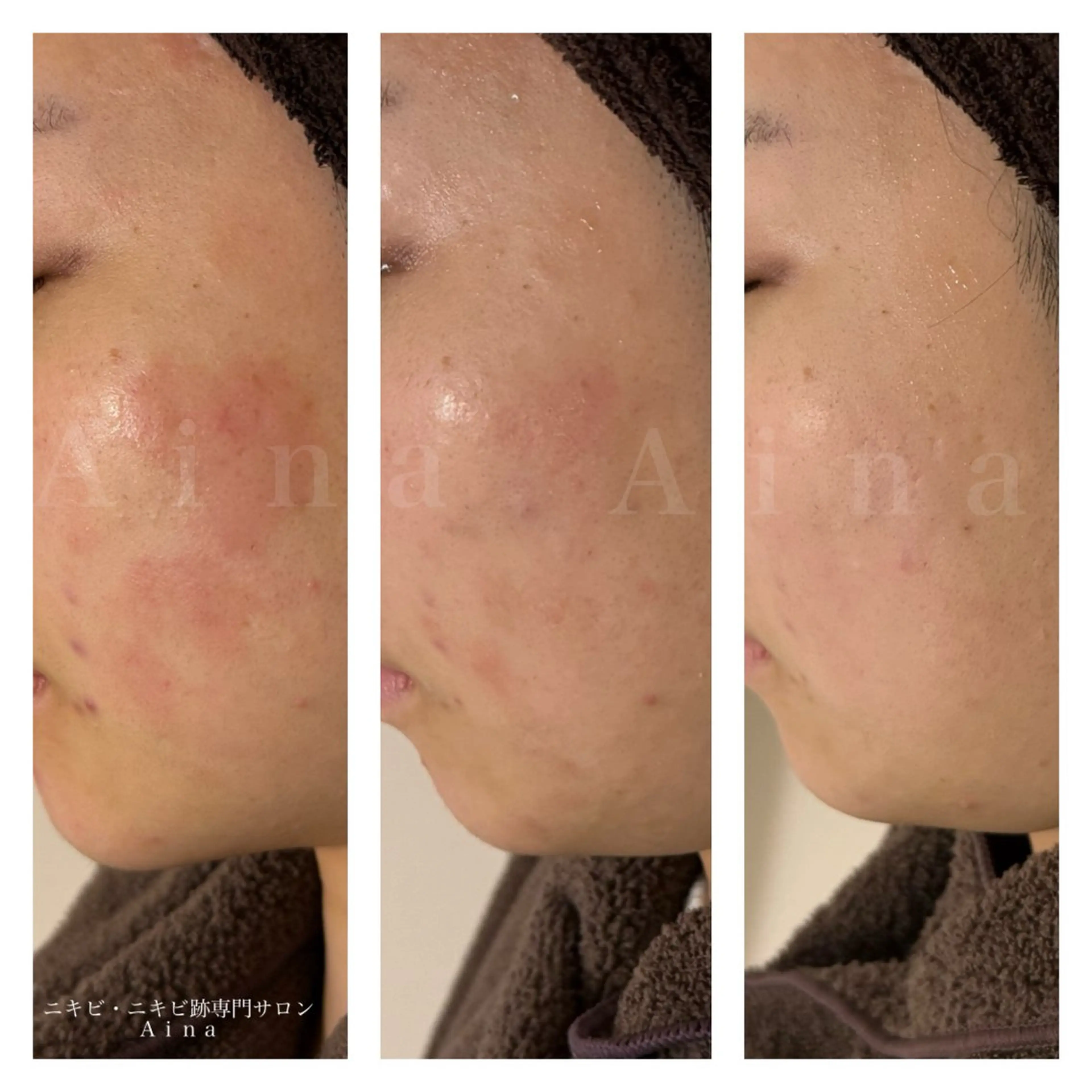 エステ リラク ニキビ跡専門サロン Ａｉｎａのエステ・リラクイメージ