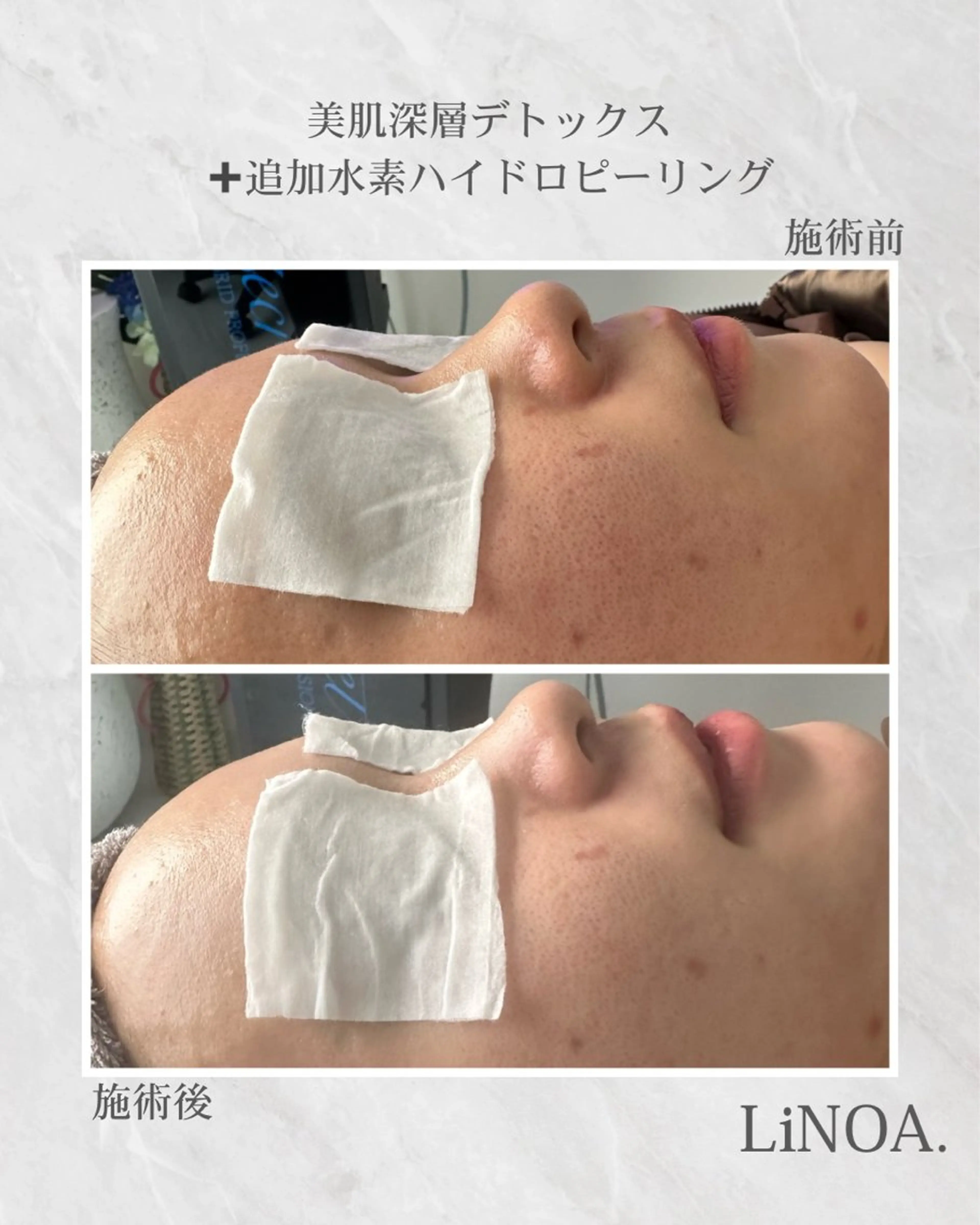 美肌深層デトックス(むくみ・肩こり)の写真