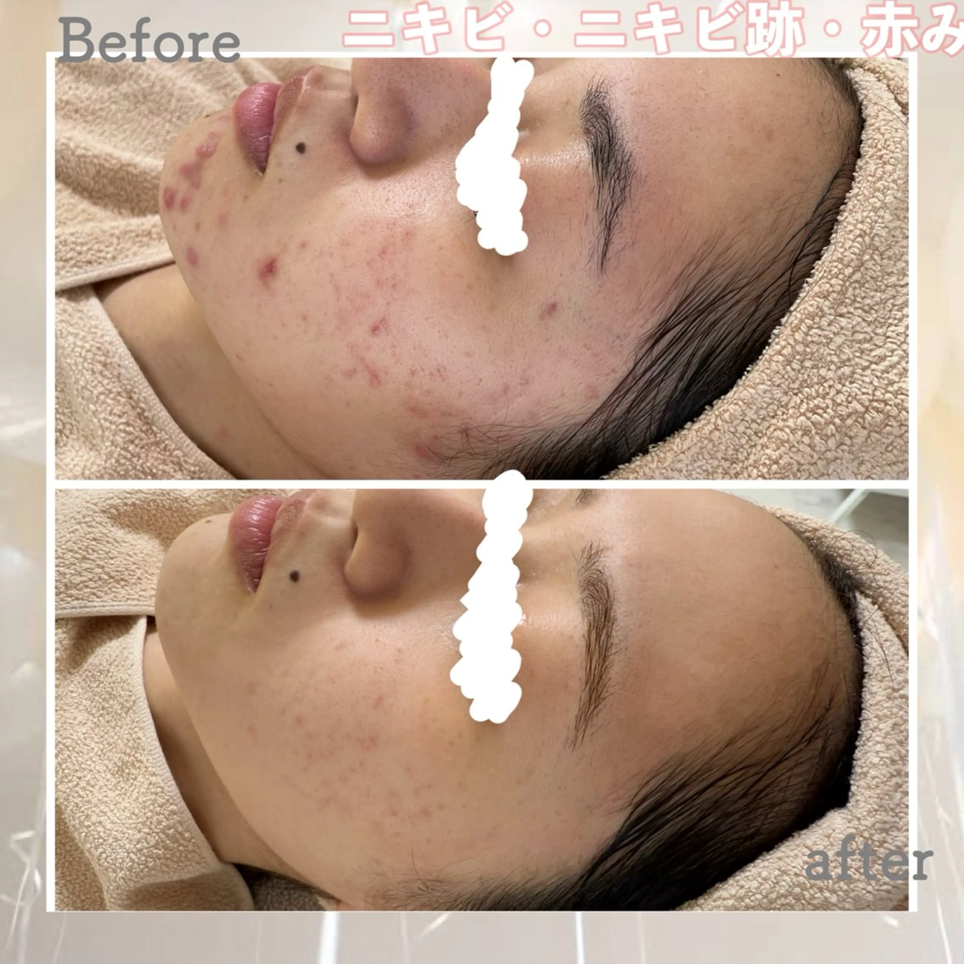 エステ ニキビ&跡改善サロン オーナー光木のエステ・リラクイメージ