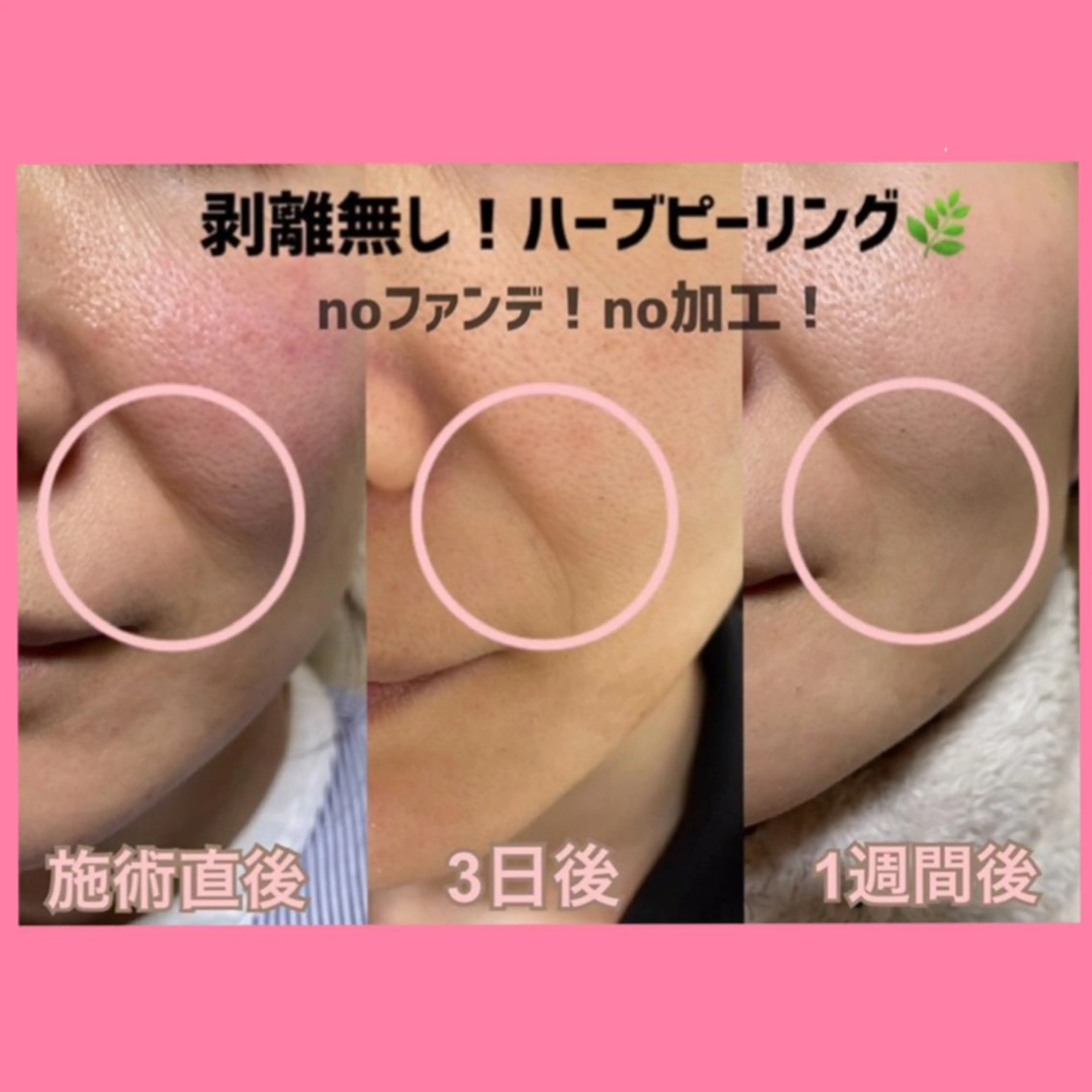 ハーブピーリング【ニキビケア×シミケア】新アプローチ!剥離から肌育へ◆全顔ハーブピーリング+高保湿パック¥8900の写真