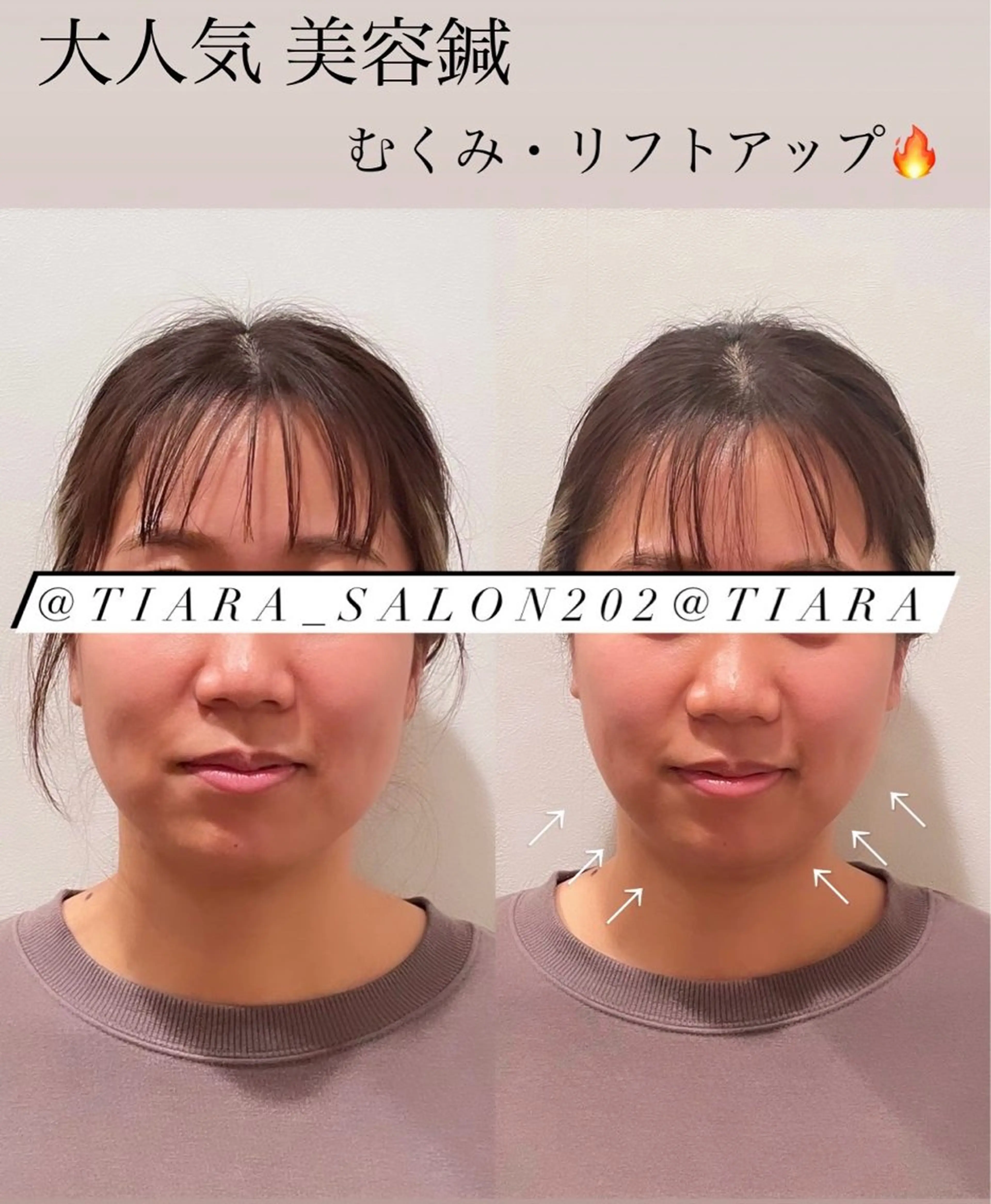 美容鍼灸サロン　TIARA所属・鍼灸サロン TIARA　美容鍼のエステ・リラクイメージ