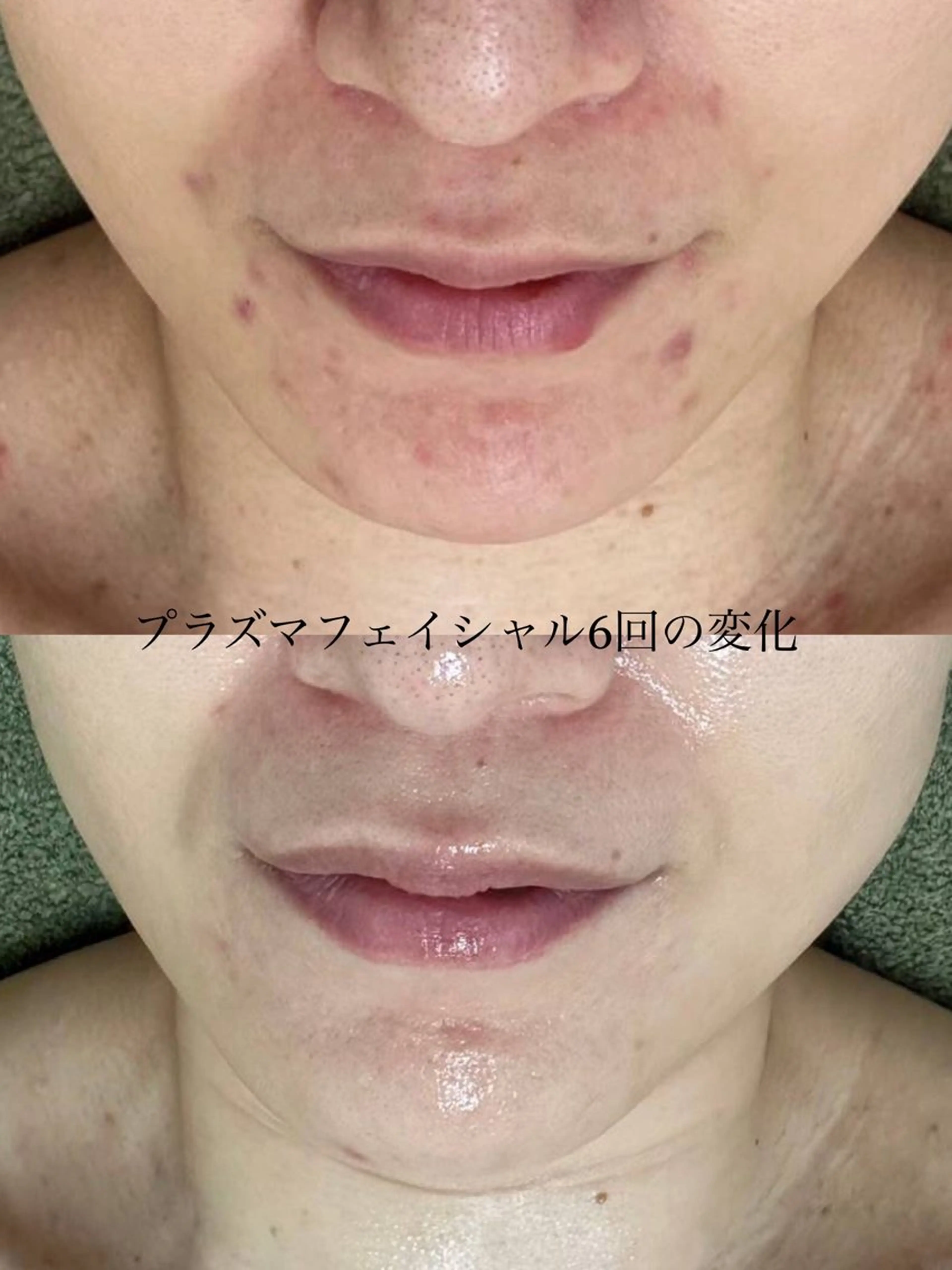 エステ 韓国美肌/肌質改善 【天神】yuiのエステ・リラクイメージ