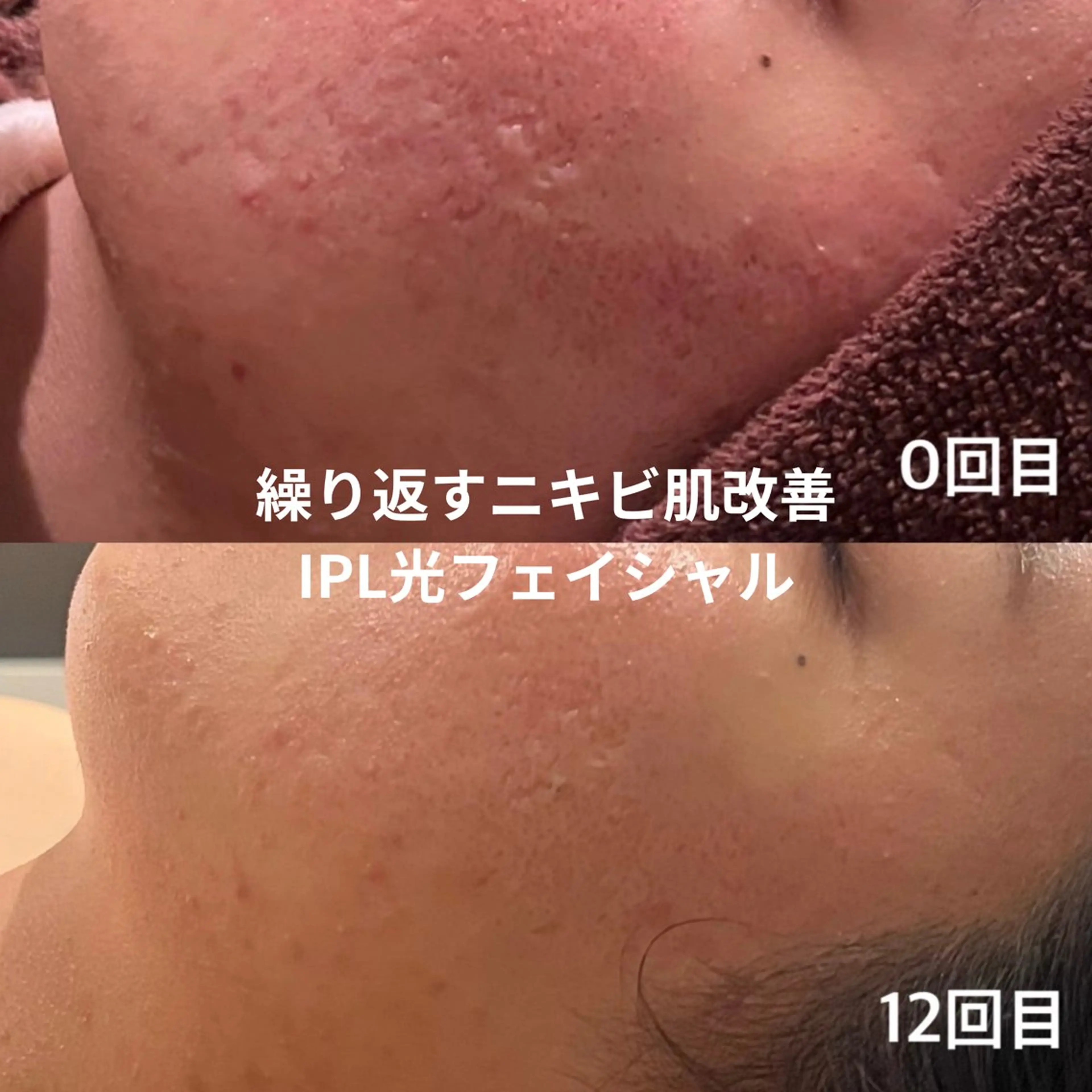 光フェイシャル|赤み・ニキビ跡・くすみ改善の写真