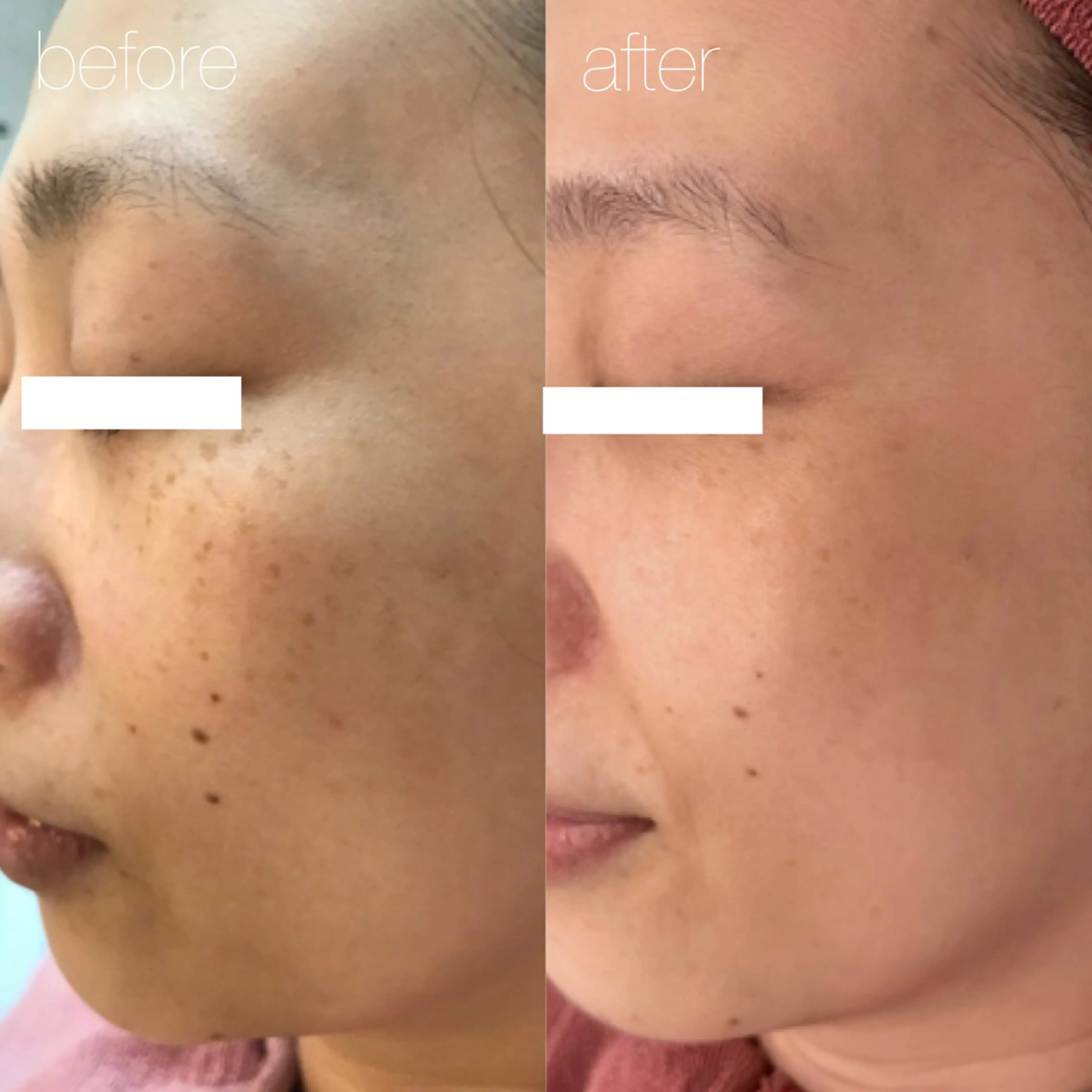 【4月ミニモ限定】シミケアトリートメント10分当て放題の写真