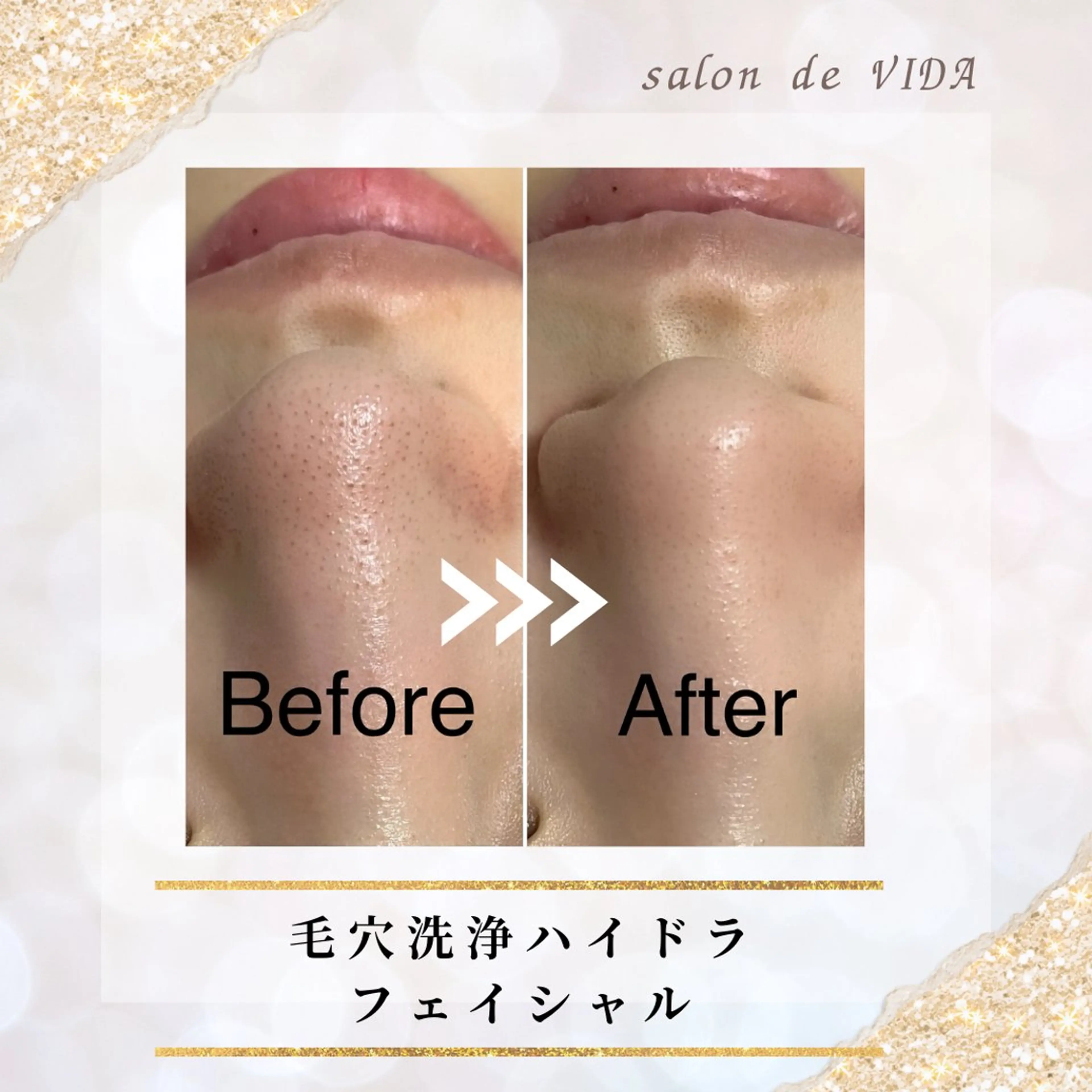 【再来予約専用】ハイドラフェイシャルの写真