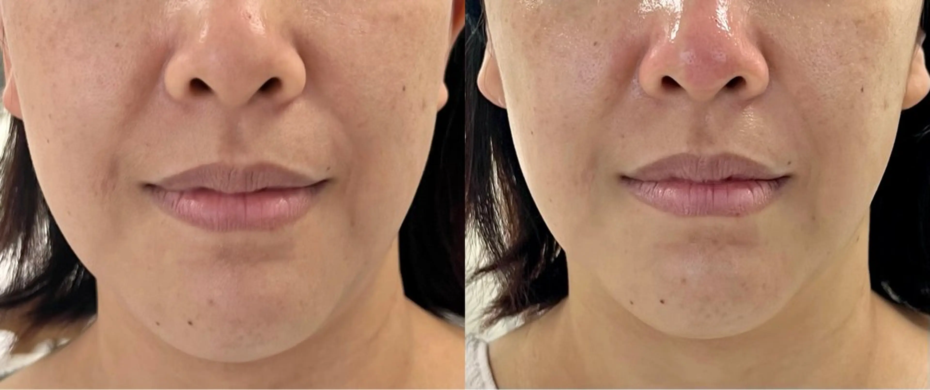 韓国　芸能ピーリング　水光肌ピーリングの写真