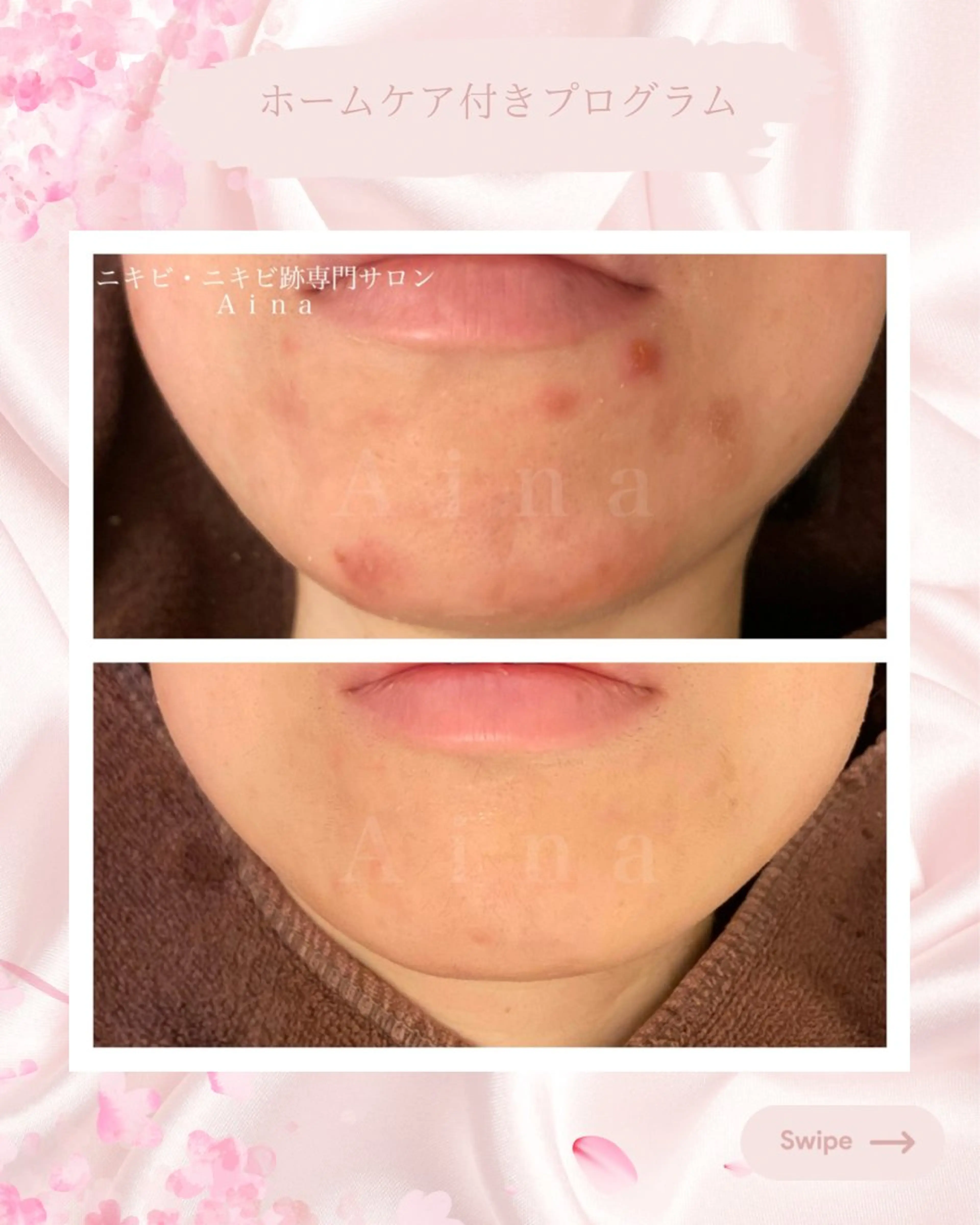 ニキビ跡専門サロン Ainaのエステ・リラクイメージ