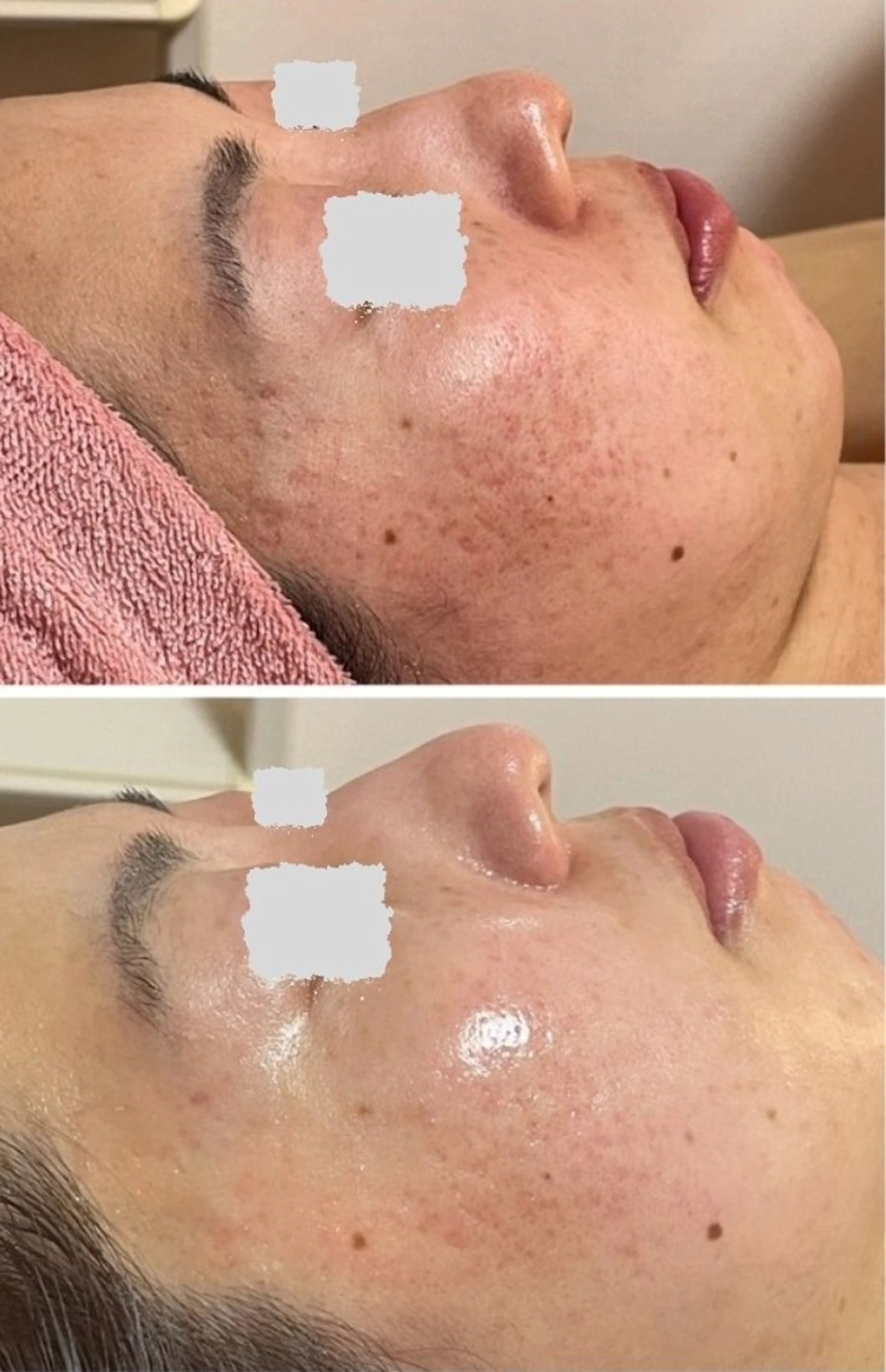 【ニキビのできにくい肌質へ】皮脂・ニキビ集中ハーブピーリング　陶肌パウダー1gプレゼント&半顔体験プレゼントの写真