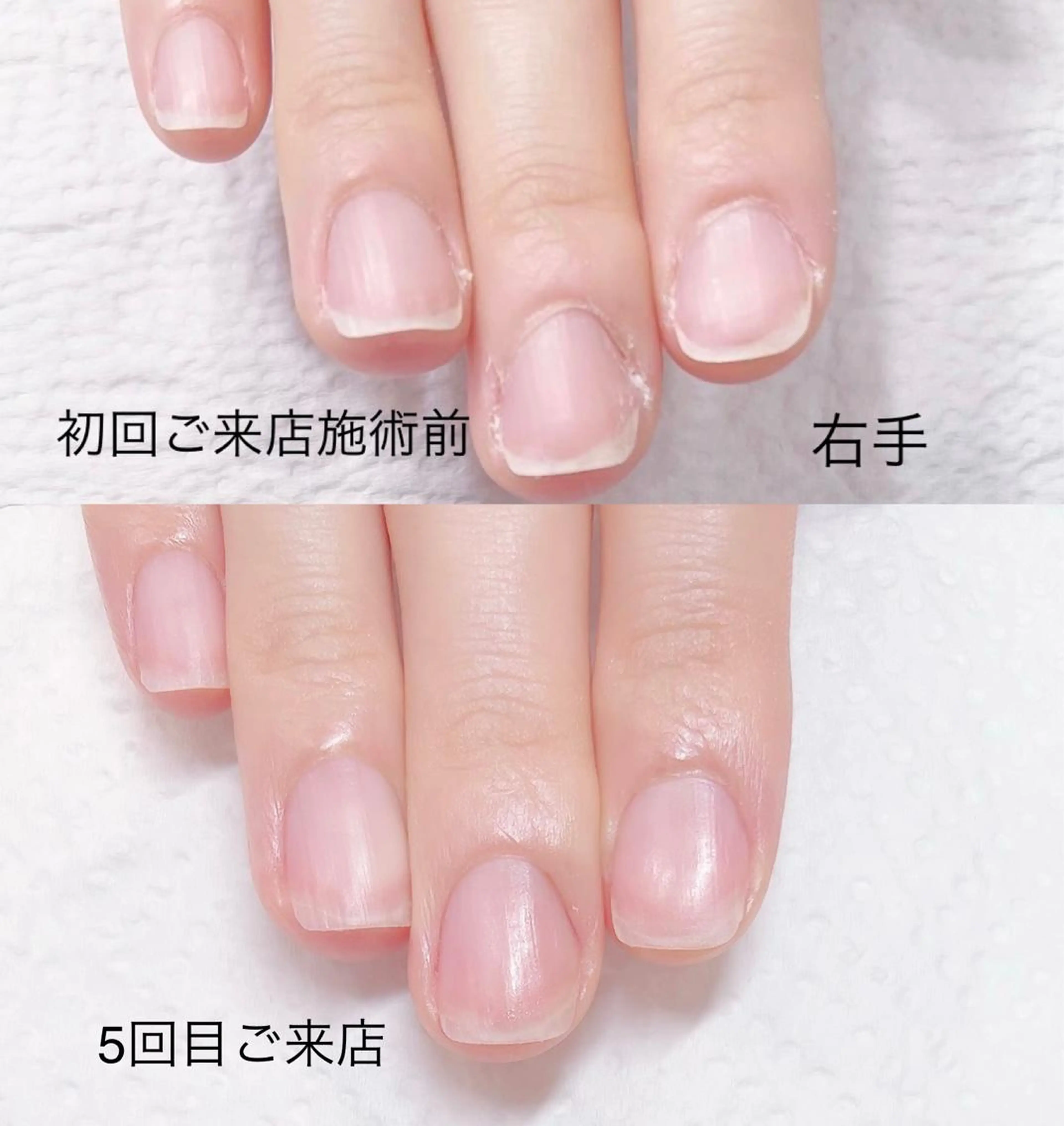 《ハンド短期集中深爪矯正アクリル使用》施術合計4回(ご来店目安3週に1回)オフ込の写真