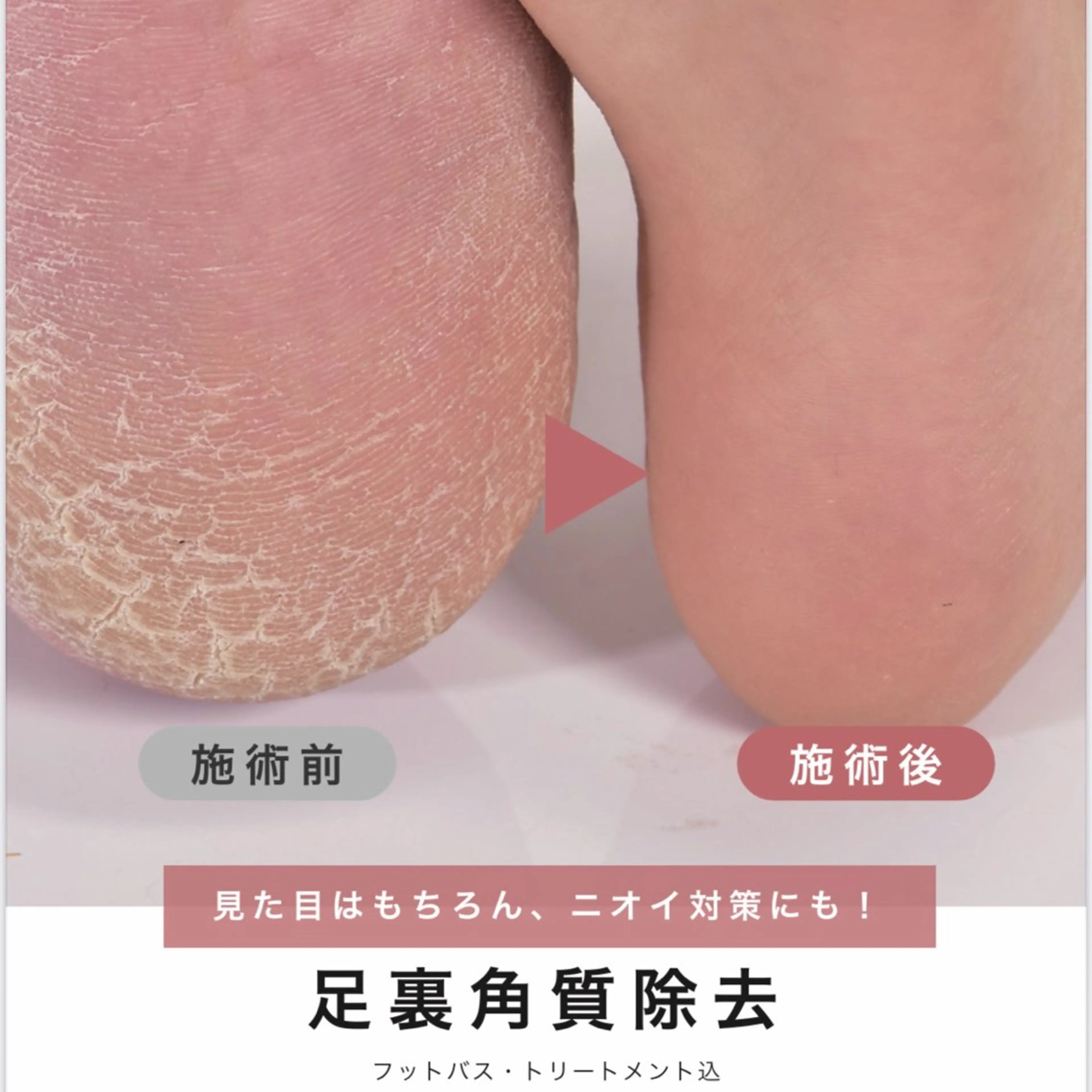 【🛁フット角質ケア】足裏 角質ケア（フットバス＆保湿付✨)の写真