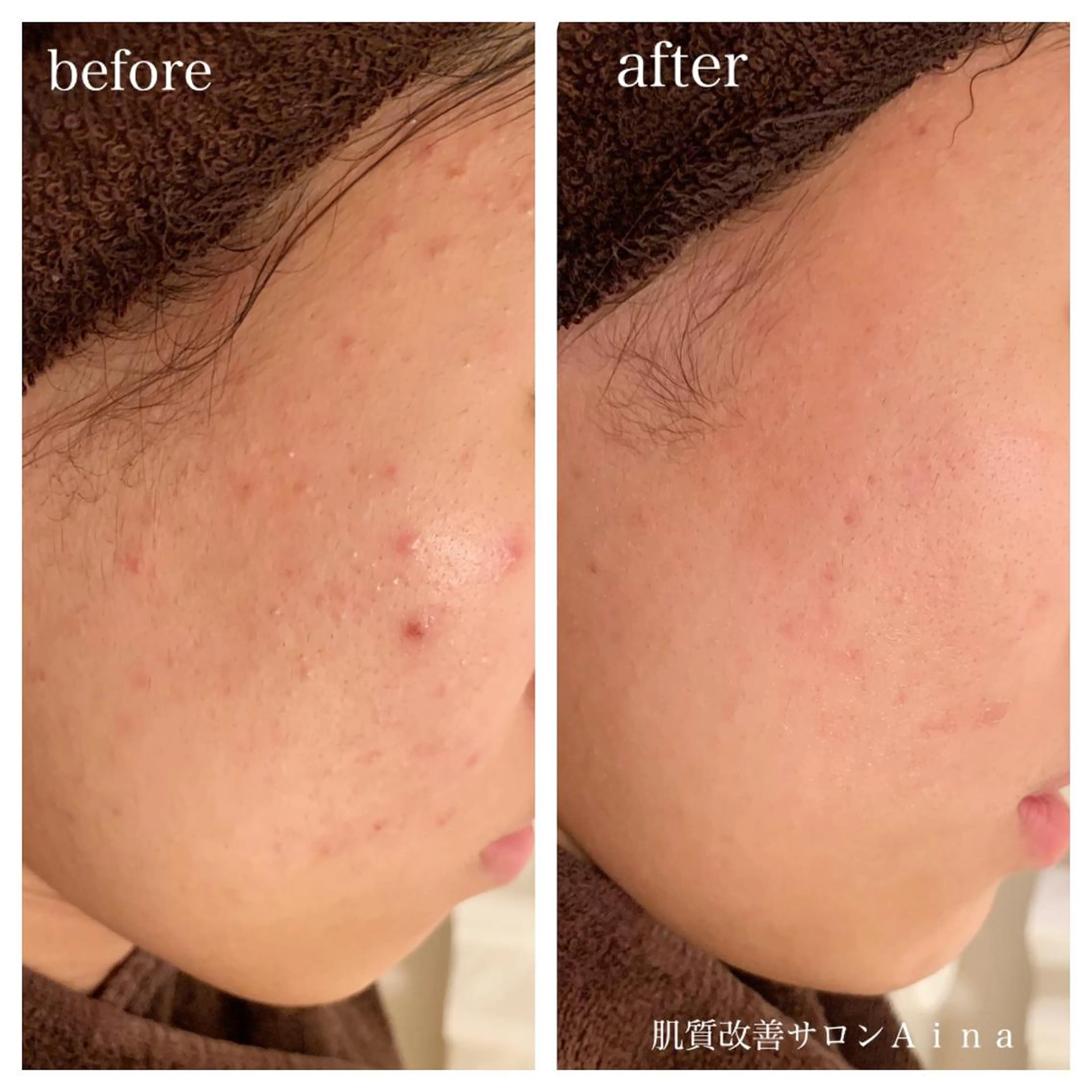 セミロング カラー パーマ ヘアアレンジ メンズ キッズ ネイル マツエク・マツパ 卒業式のヘアスタイル 卒業式 エステ リラク ニキビ跡専門サロン Ａｉｎａのエステ・リラクイメージ