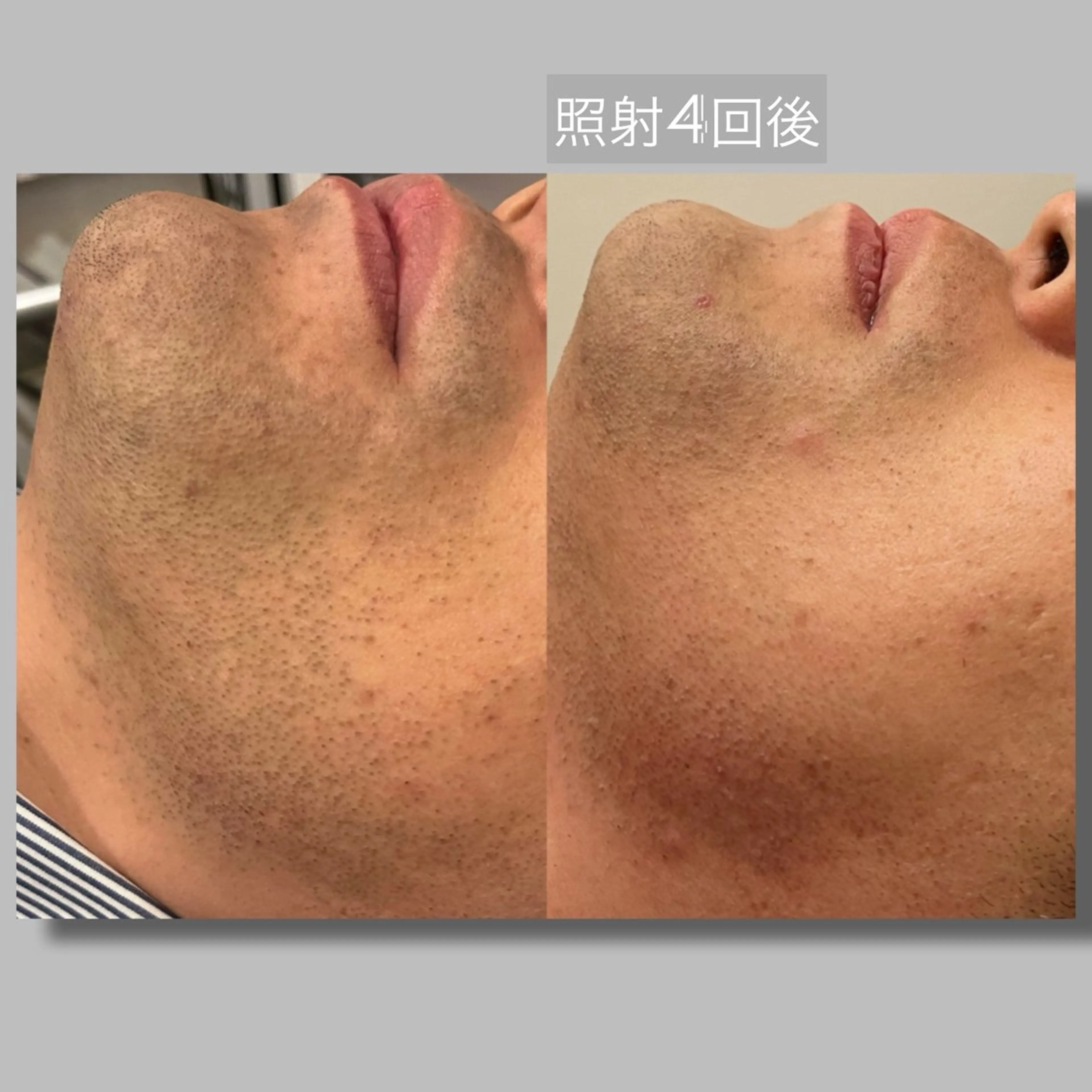 メンズ ☆痩身/小顔☆ コルギのエステ・リラクイメージ