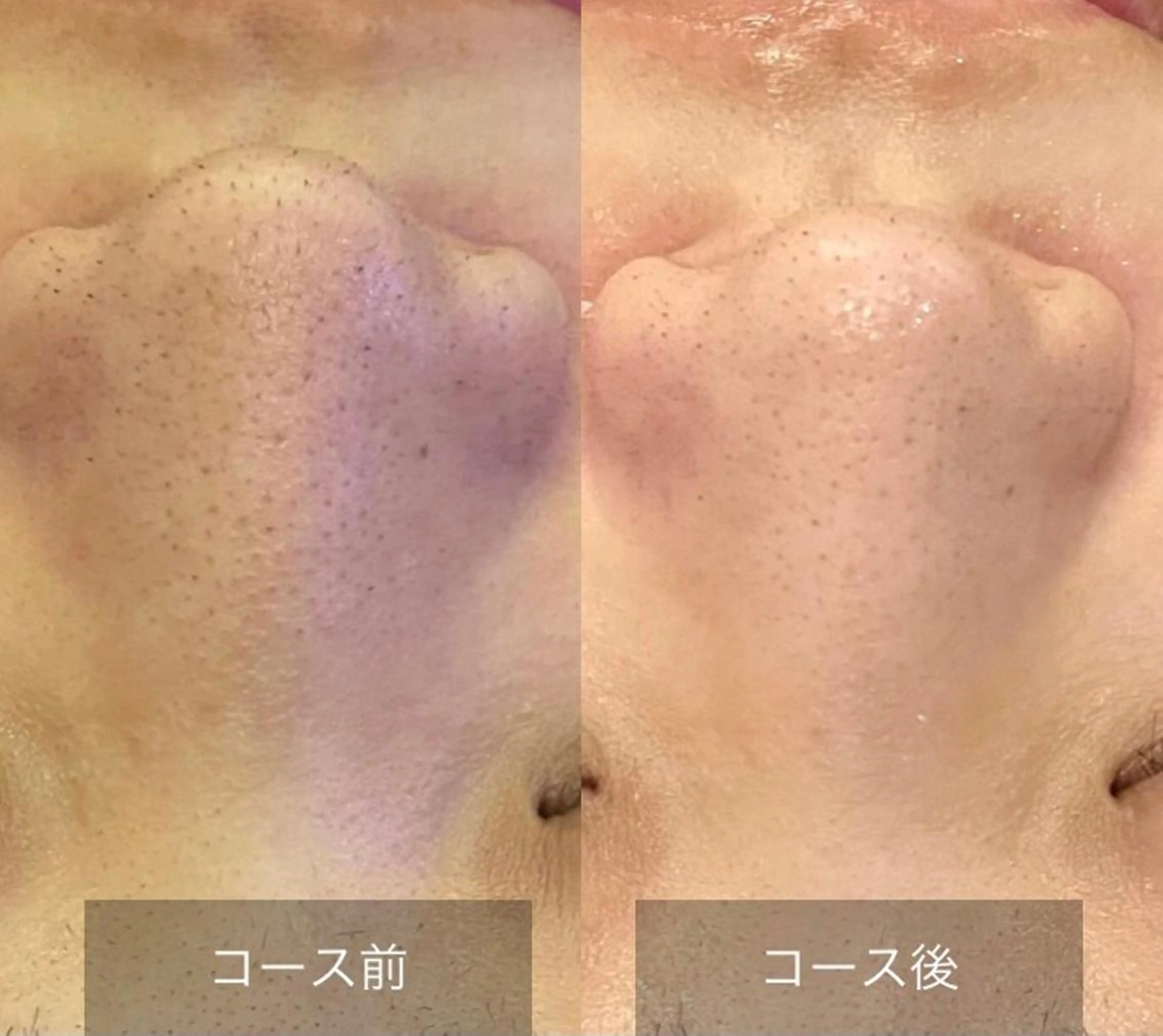 【フェイシャル🩵🩷】 ハイドロ毛穴洗浄 30分〈毛穴の黒ずみとお別れ！〉の写真