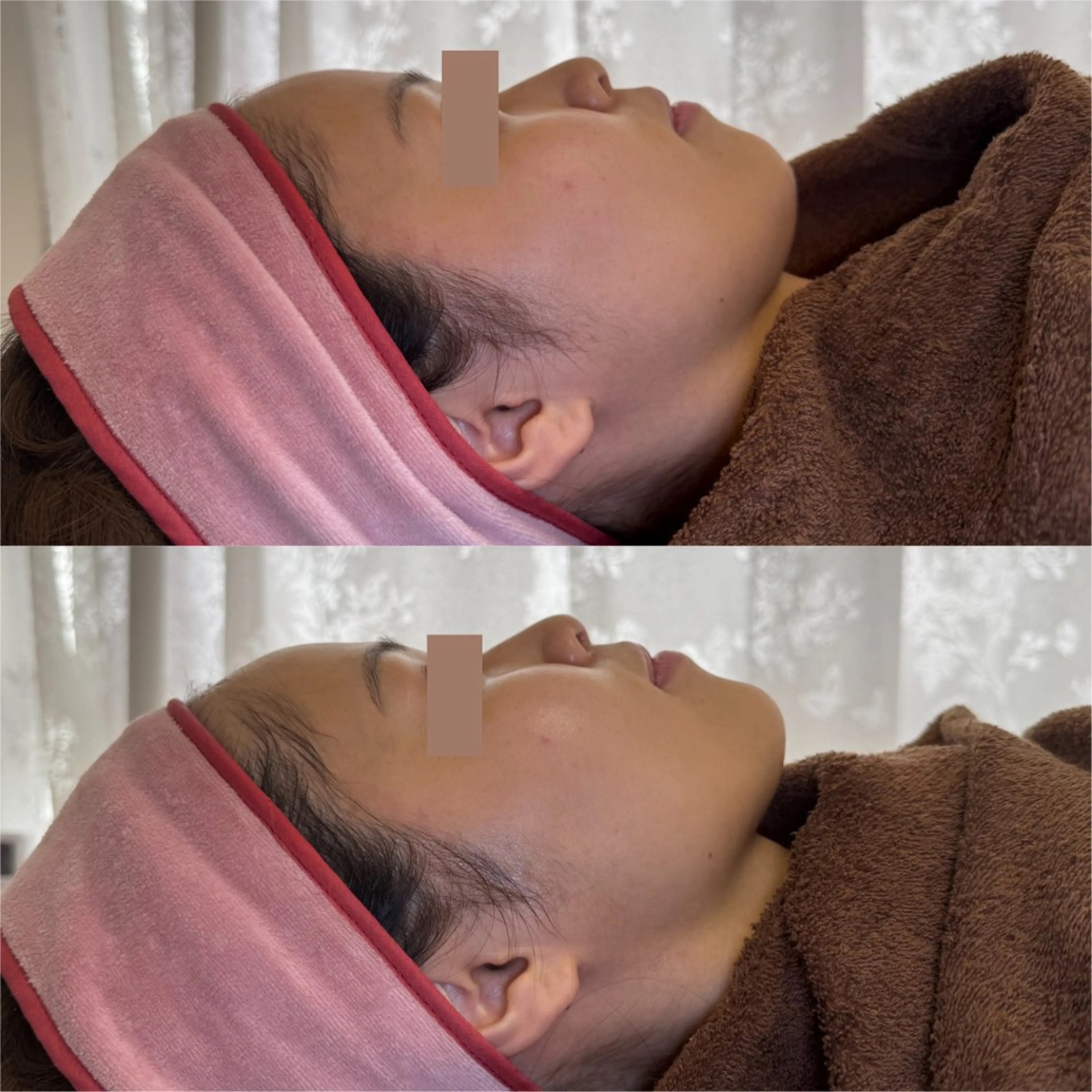 【引き締め×小顔】RF小顔フェイシャル｜サーマトリックス(オリジオ同様効果✨)の写真