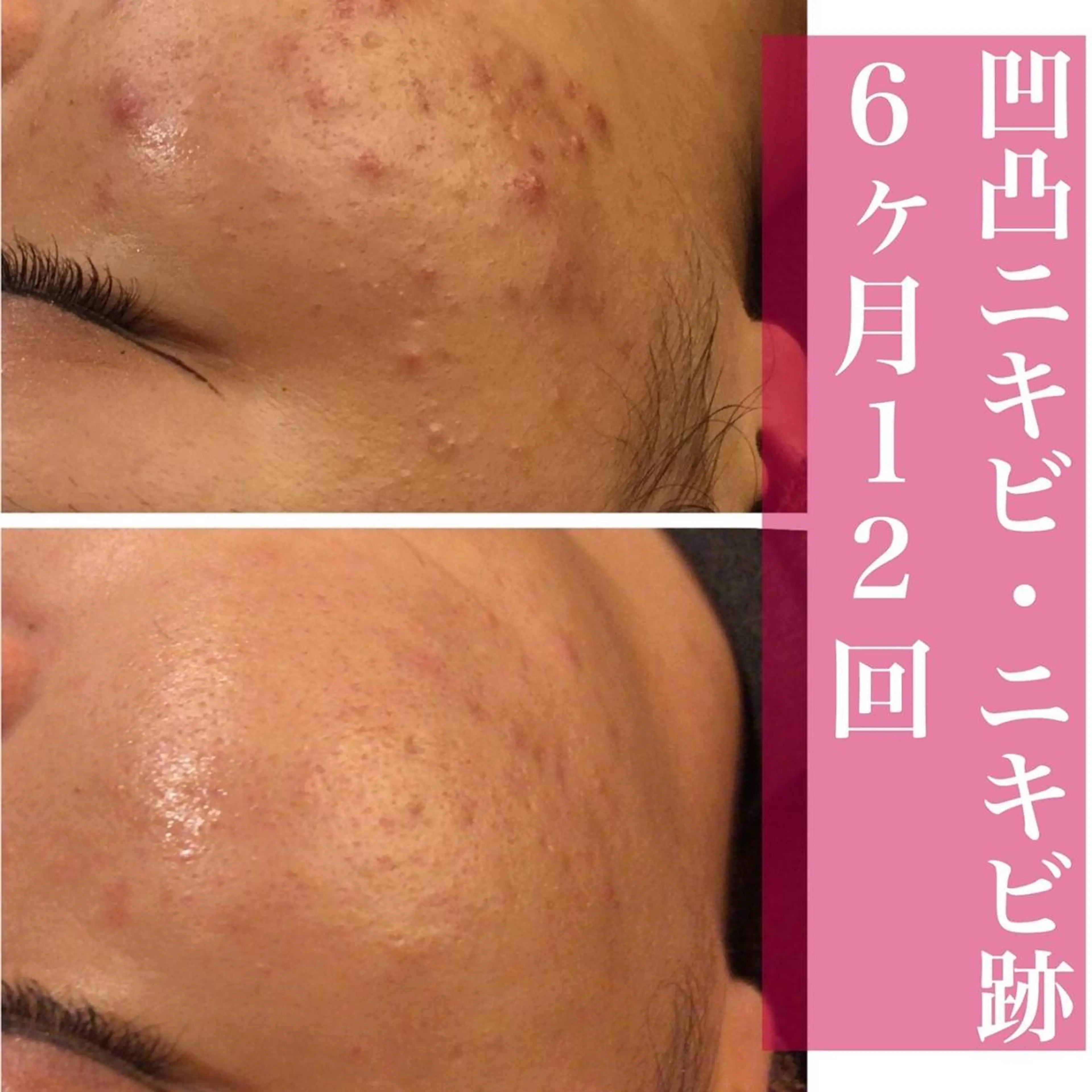 エステ リラク ニキビ特化型エステ 🍓最短で肌質改善のエステ・リラクイメージ