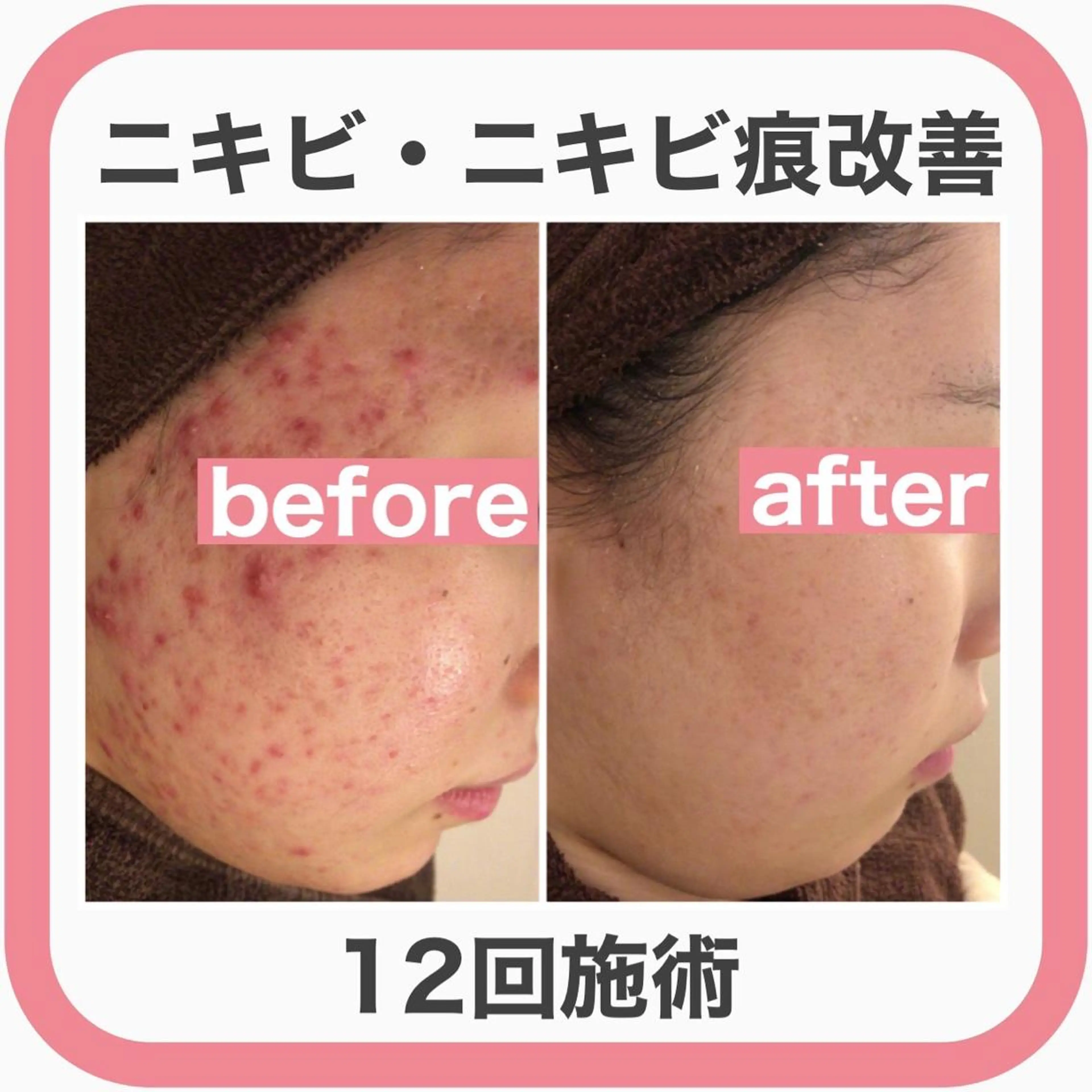 セミロング カラー パーマ ヘアアレンジ キッズ ネイル マツエク・マツパ 🔥3か月で肌革命 🔥ニキビ専門店のエステ・リラクイメージ