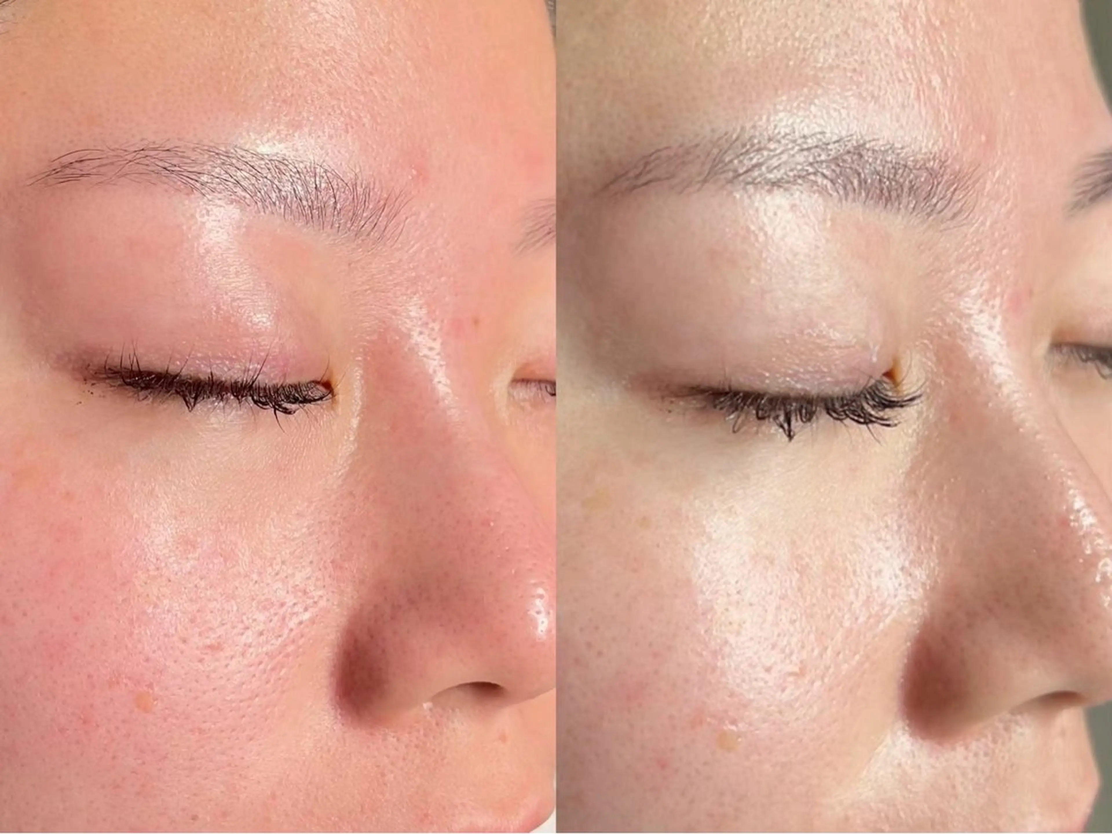 フルフェイスWAX顔脱毛×フルフェイス毛穴洗浄の写真