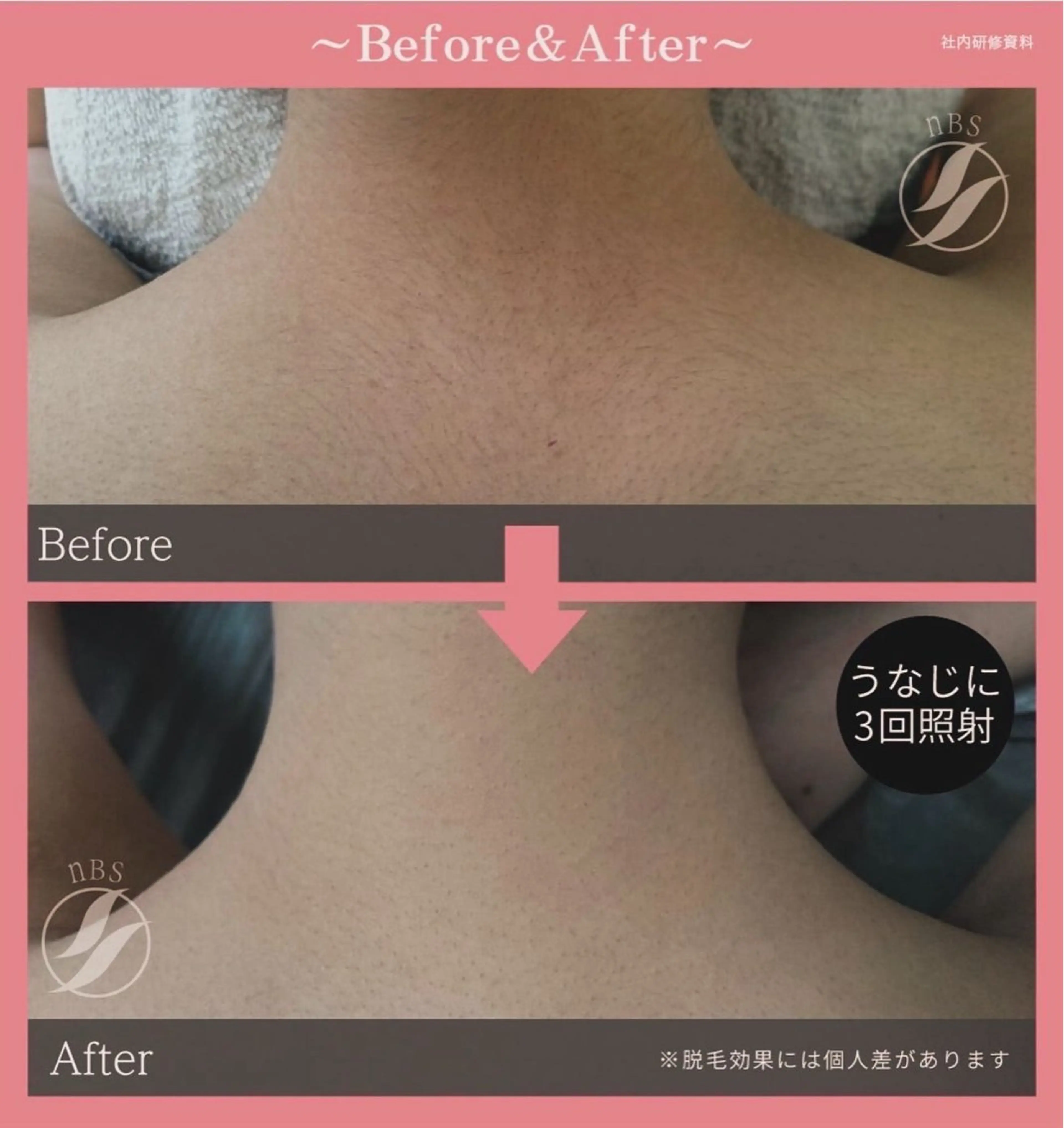 脱毛 小川 縁のエステ・リラクイメージ