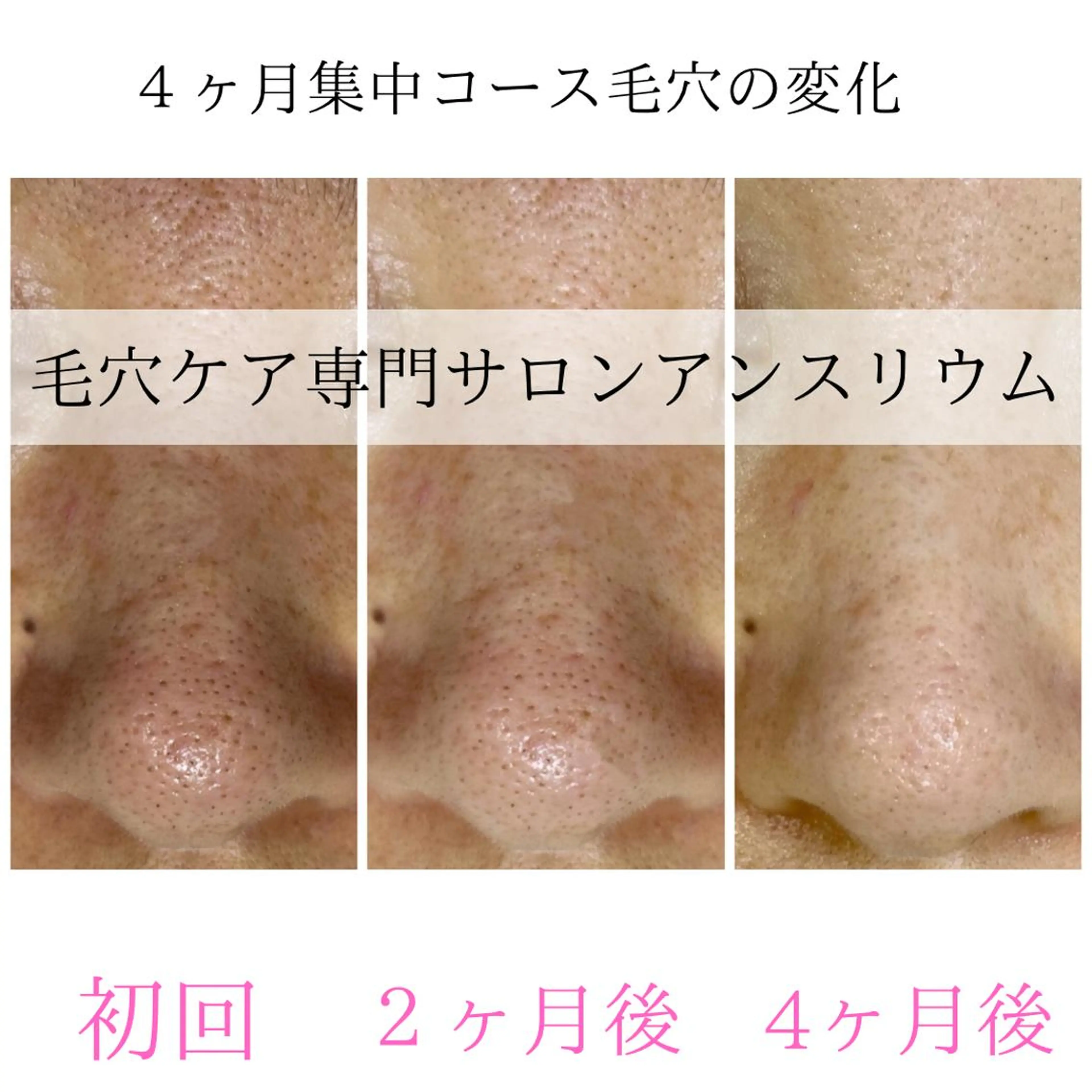 毛穴ケア専門サロンアンスリウム所属・茨城土浦 つくば毛穴 ケア専門サロンのエステ・リラクイメージ