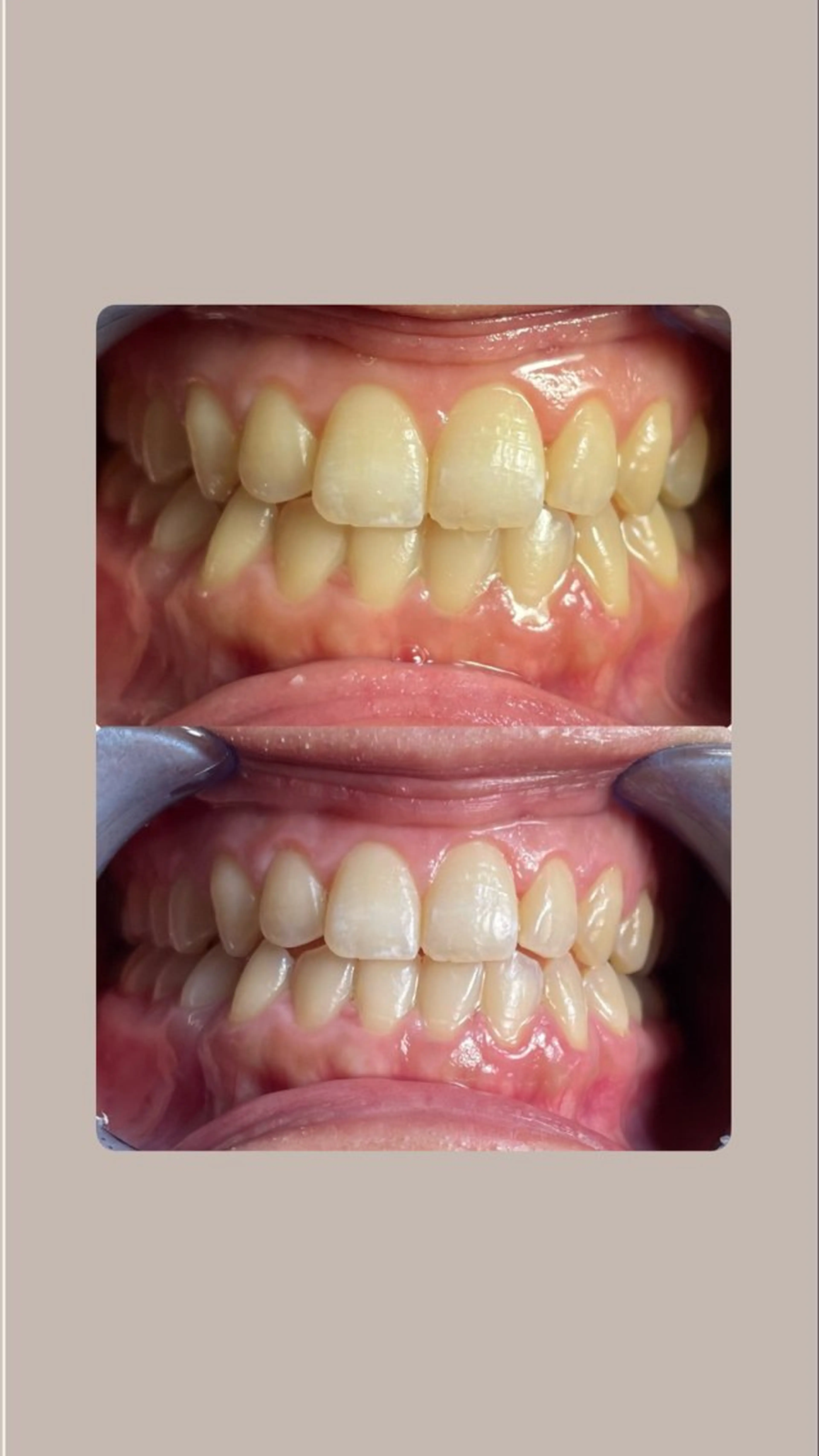 セルフホワイトニングの写真