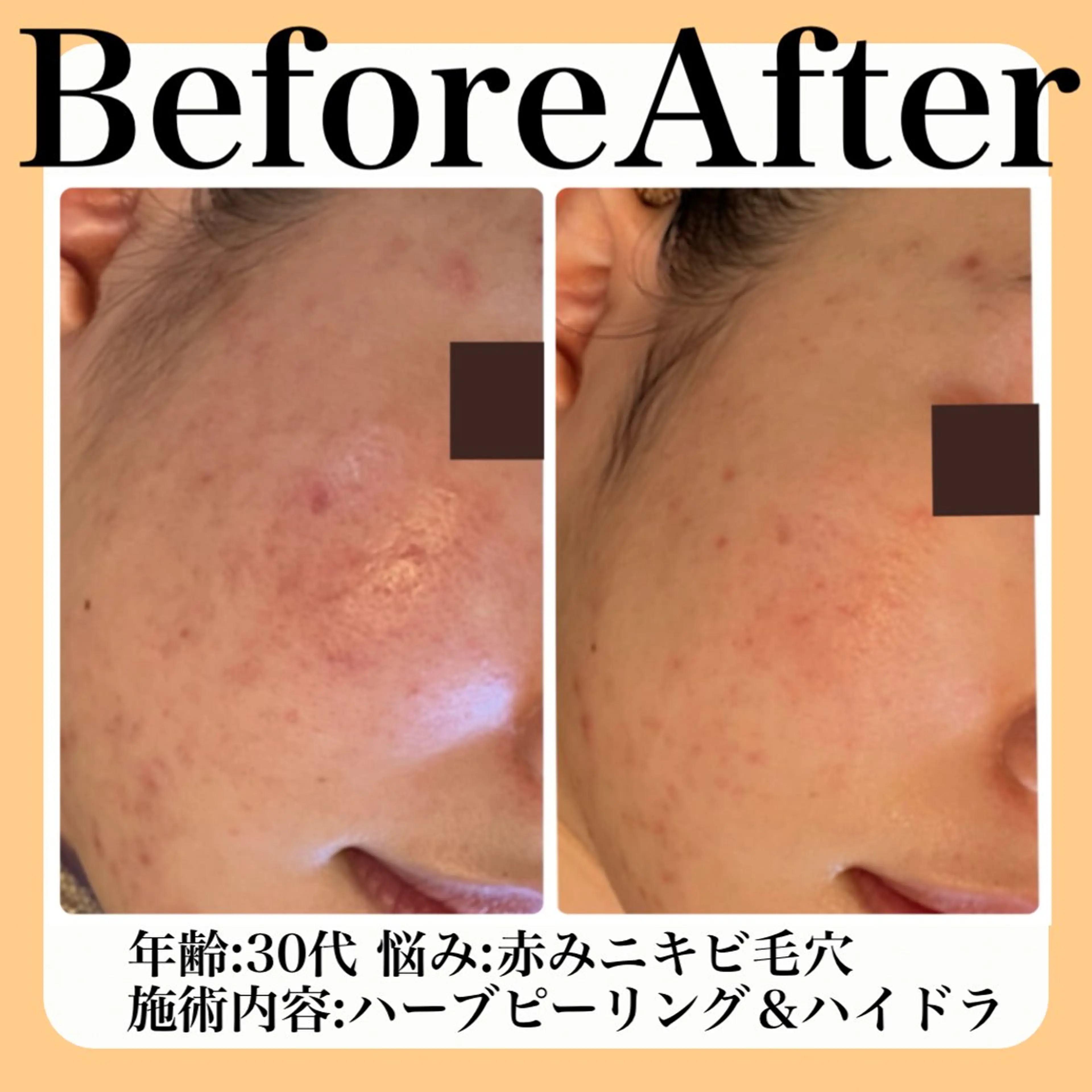 エステ 毛穴・たるみ･ニキビケア専門サロンsui所属・sui【スイ】 ARISAのエステ・リラクイメージ