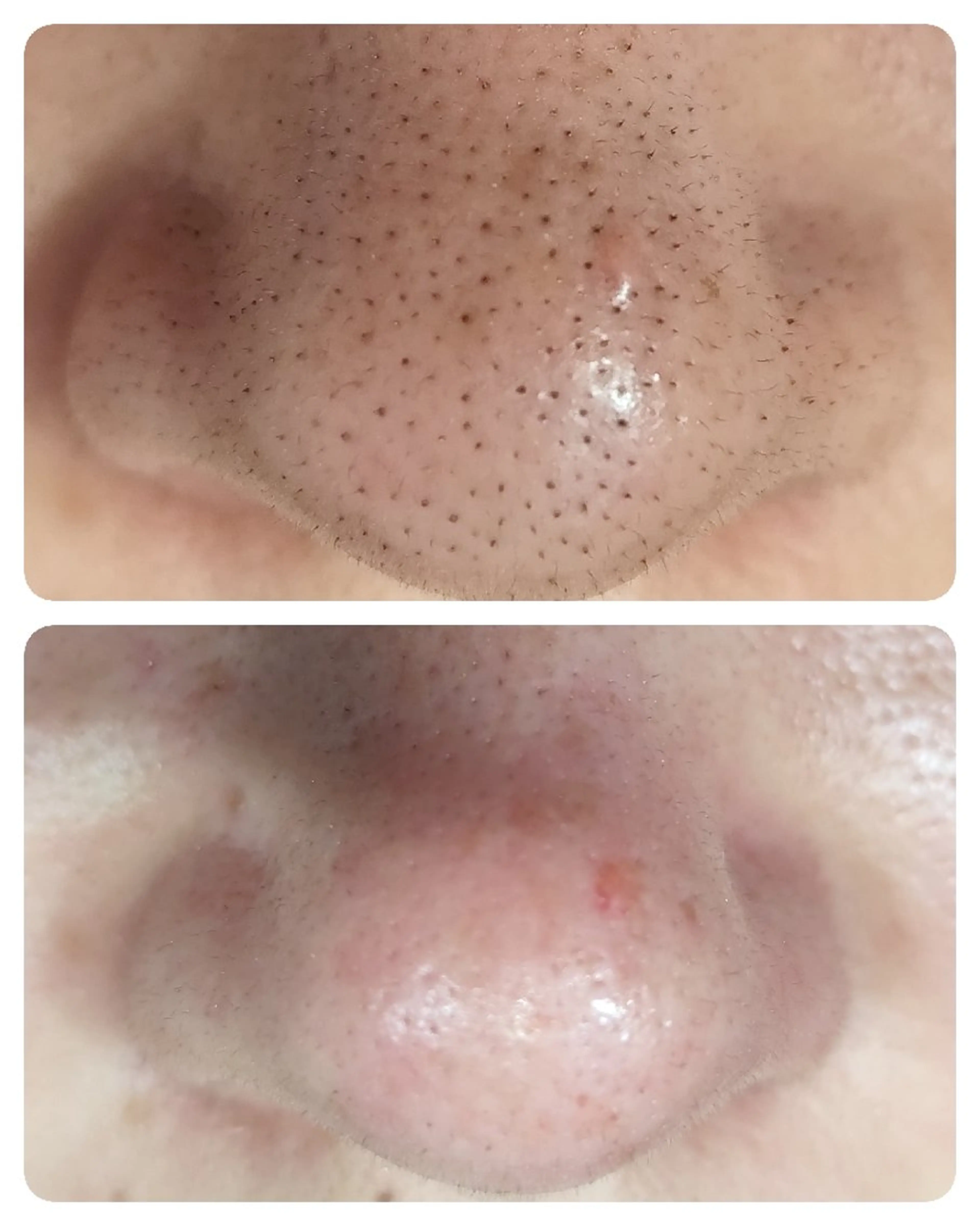 当日予約🆗ミニモ限定価格‼️毛穴の黒ずみ・いちご鼻が改善する毛穴洗浄✨の写真