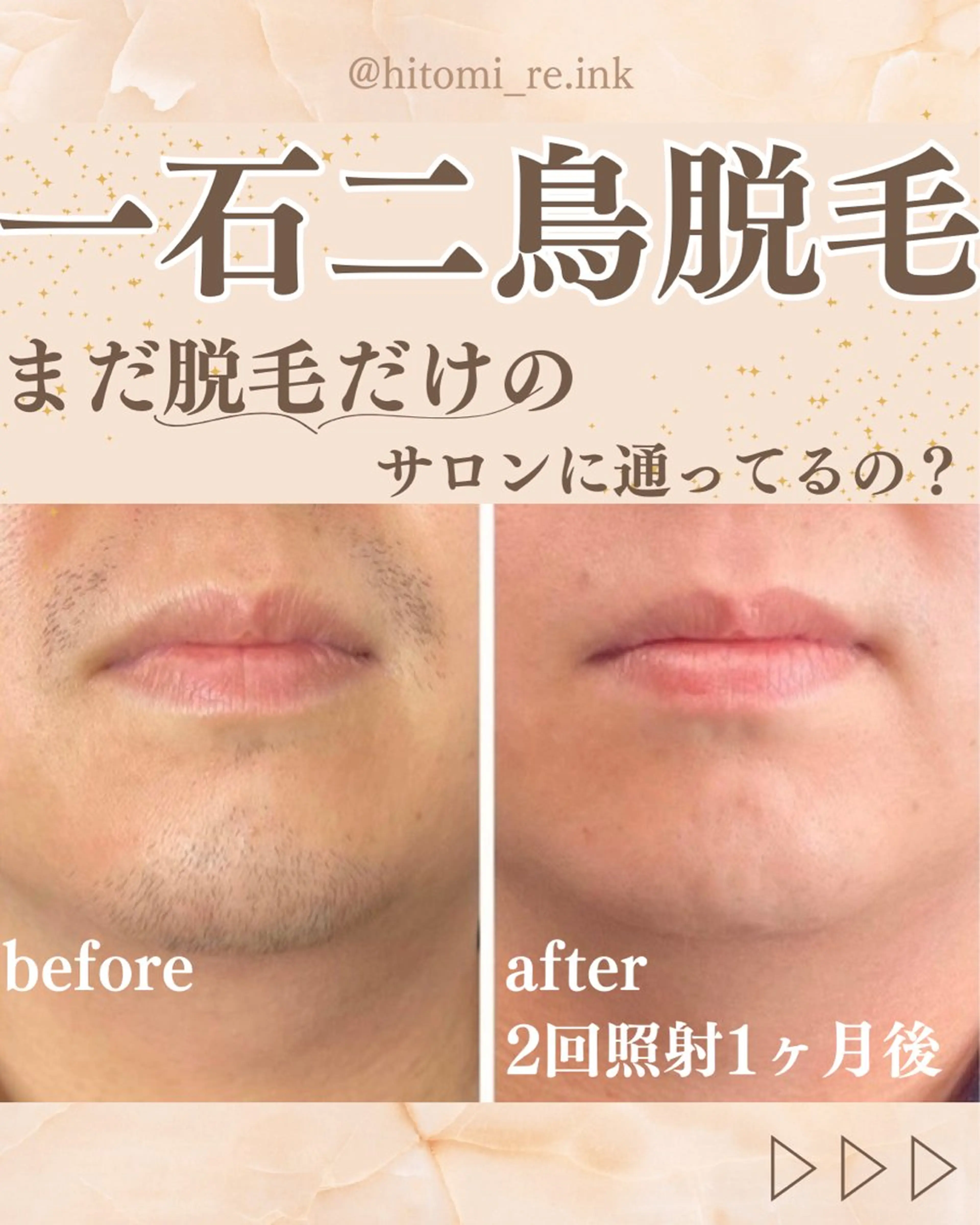 【急な予定にも対応】メンズひげ脱毛　鼻下/顎/顎下30分の写真