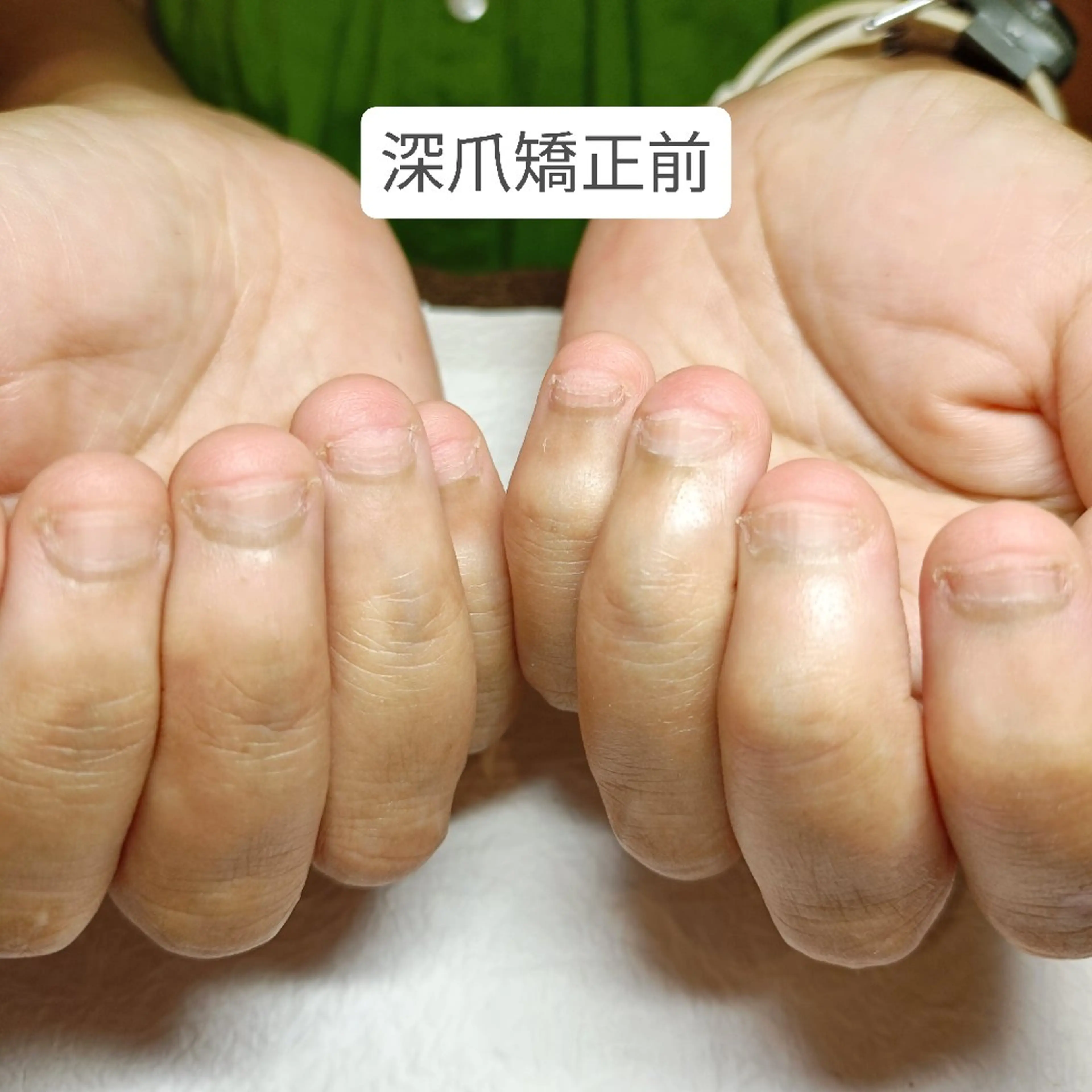 ネイル ハンドネイル ハンドケア 深爪矯正/爪育成ケア manie nailのネイルデザイン