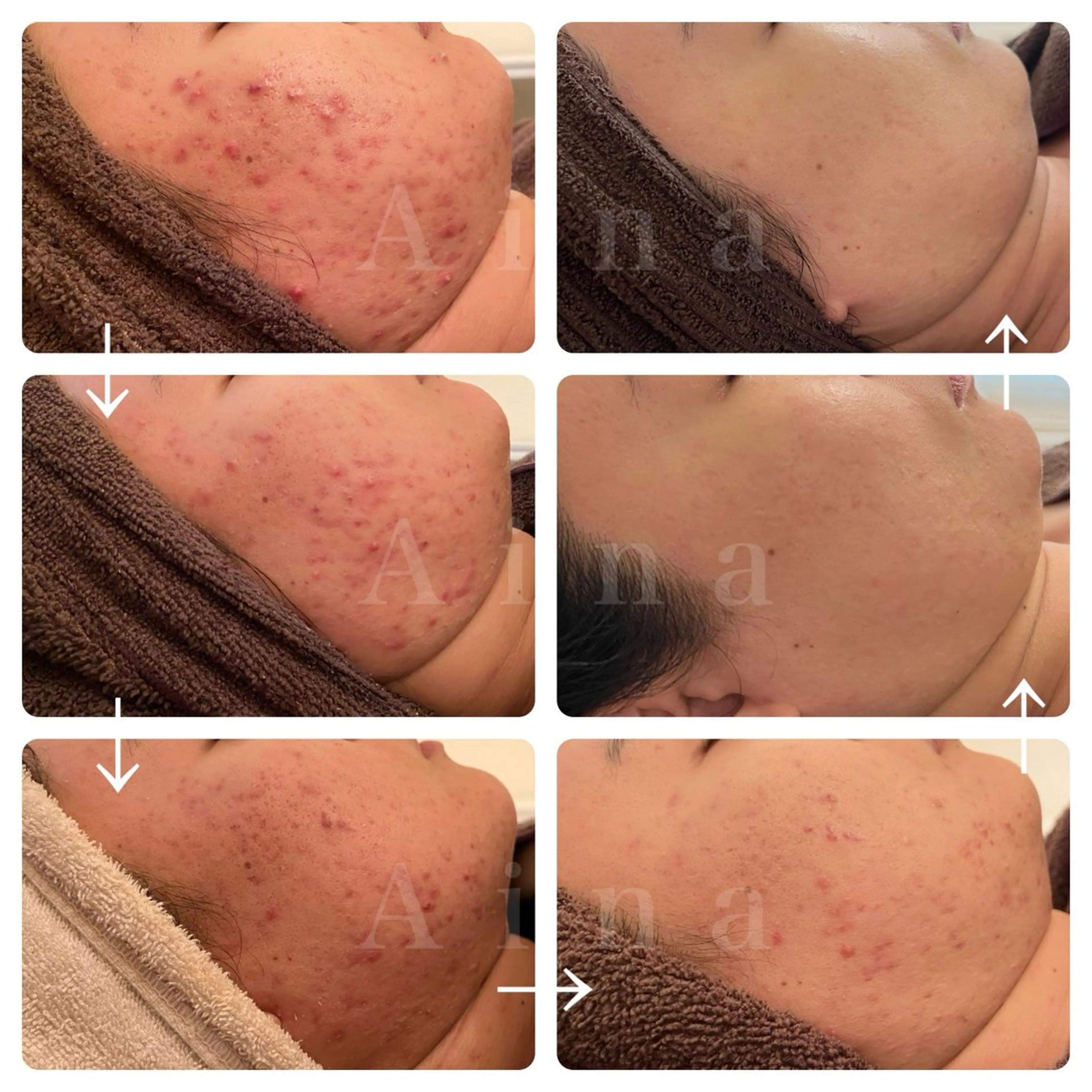 エステ リラク ニキビ跡専門サロン Ainaのエステ・リラクイメージ