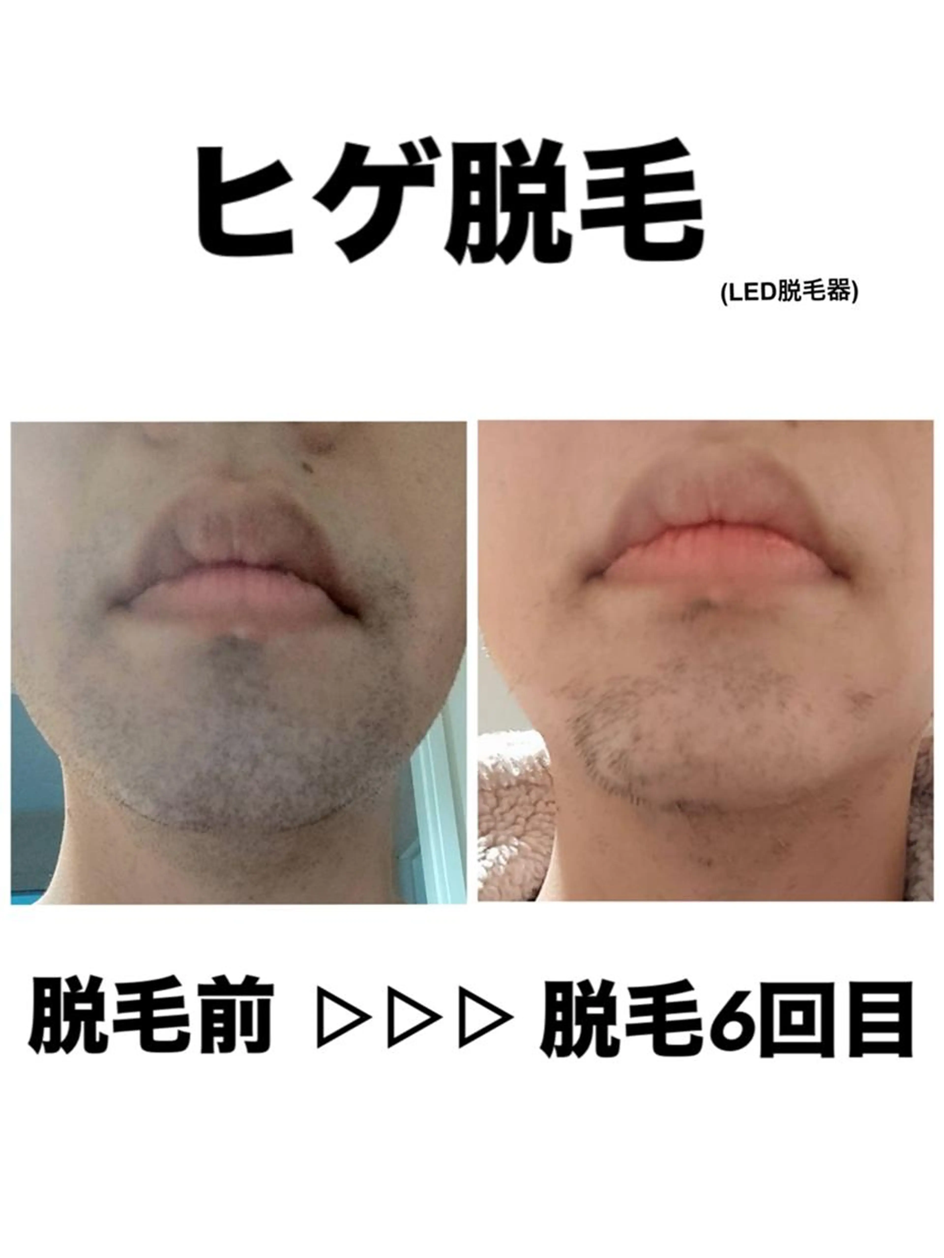 【毎朝のヒゲ剃り卒業✨時短＆清潔感UP😎🔥】 ヒゲ脱毛　通常6,000円→3,980円の写真
