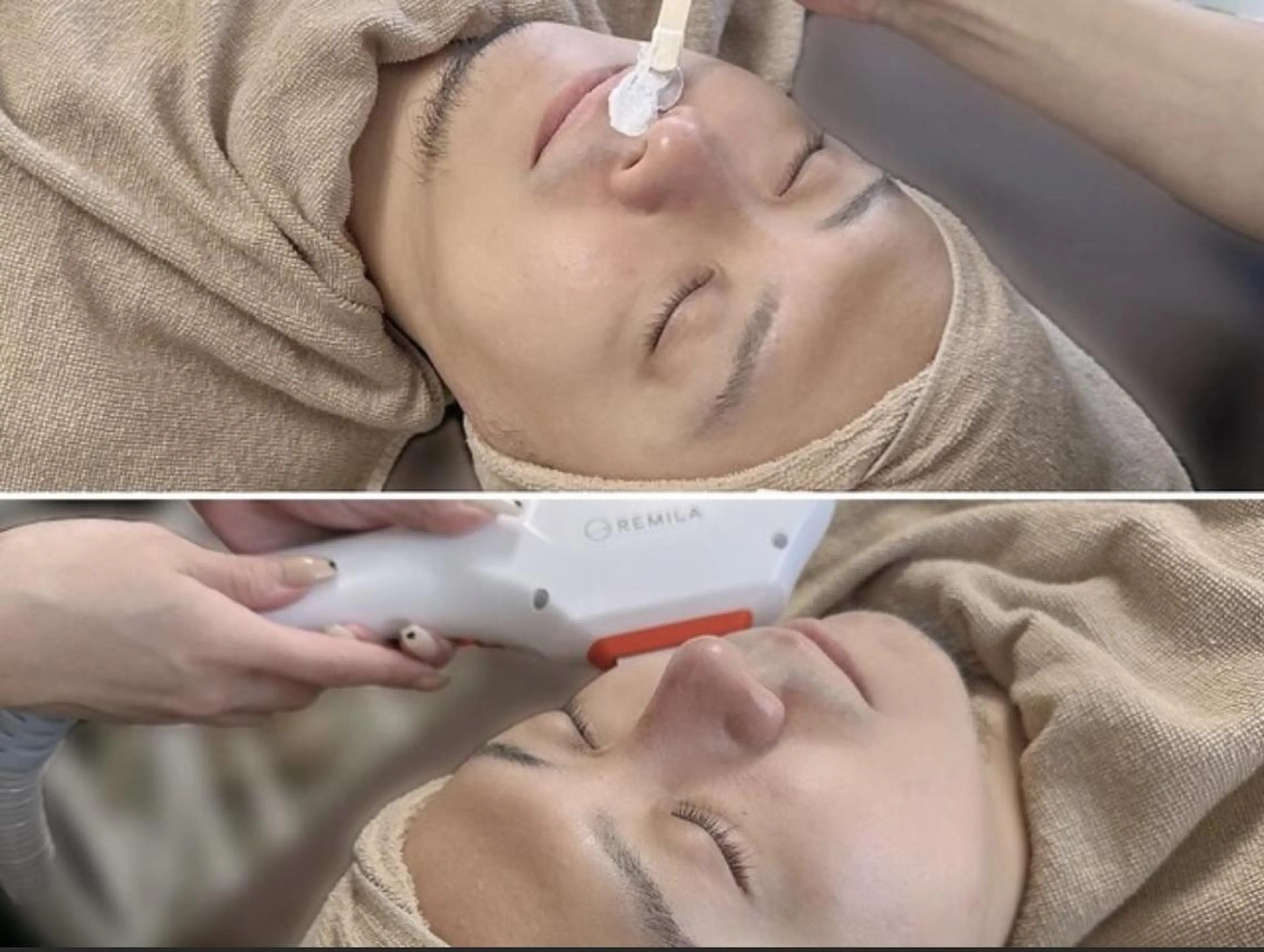 【ひげMIX(光脱毛×WAX)】(青髭卒業!)¥12500→¥6500の写真