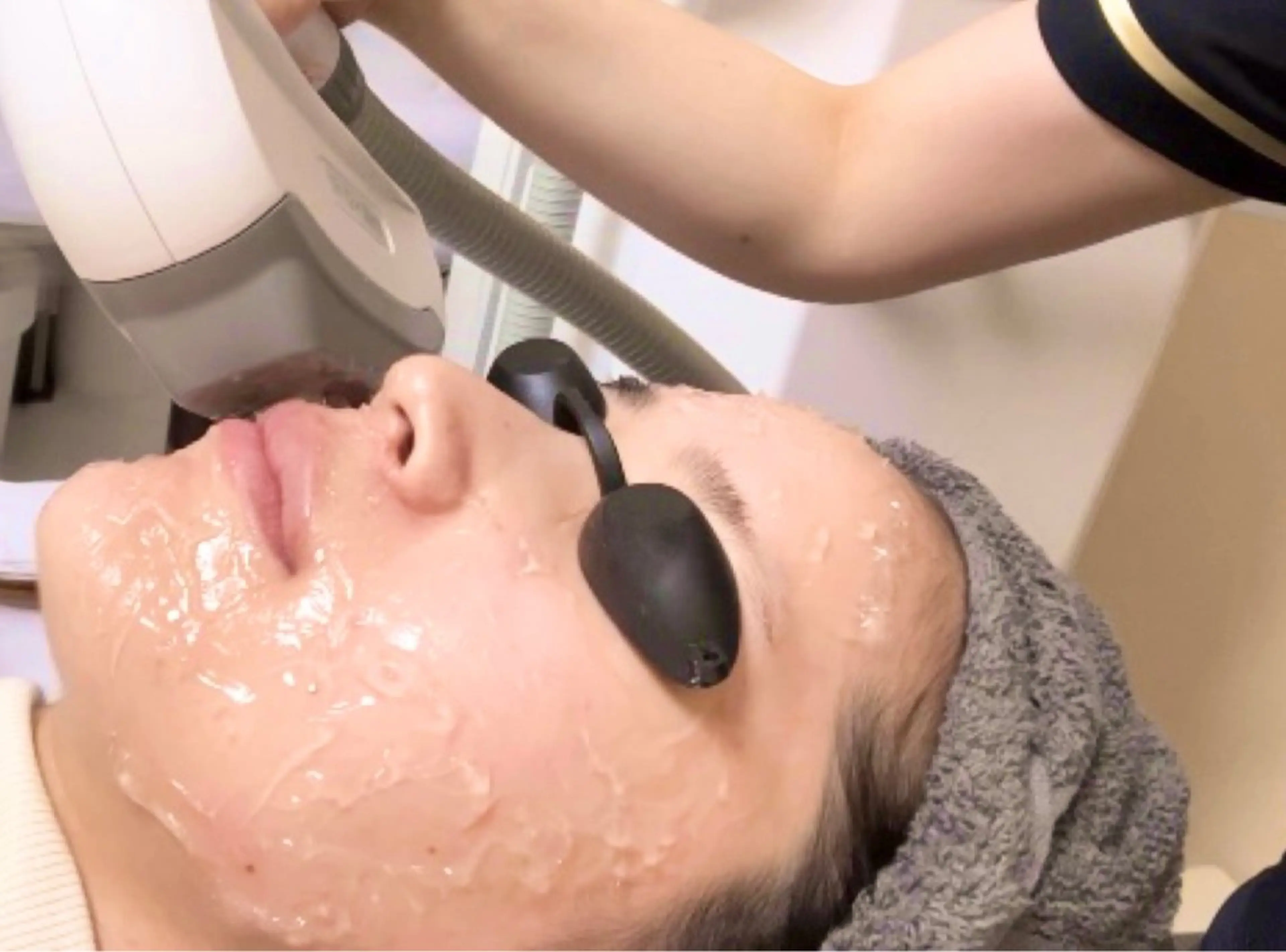 高出力IPL全顔フォトエステ＋美白パック￥5000✨《シミ&毛穴・ニキビ跡・肌質改善》✨ブライダル準備にも👰‍♀️の写真